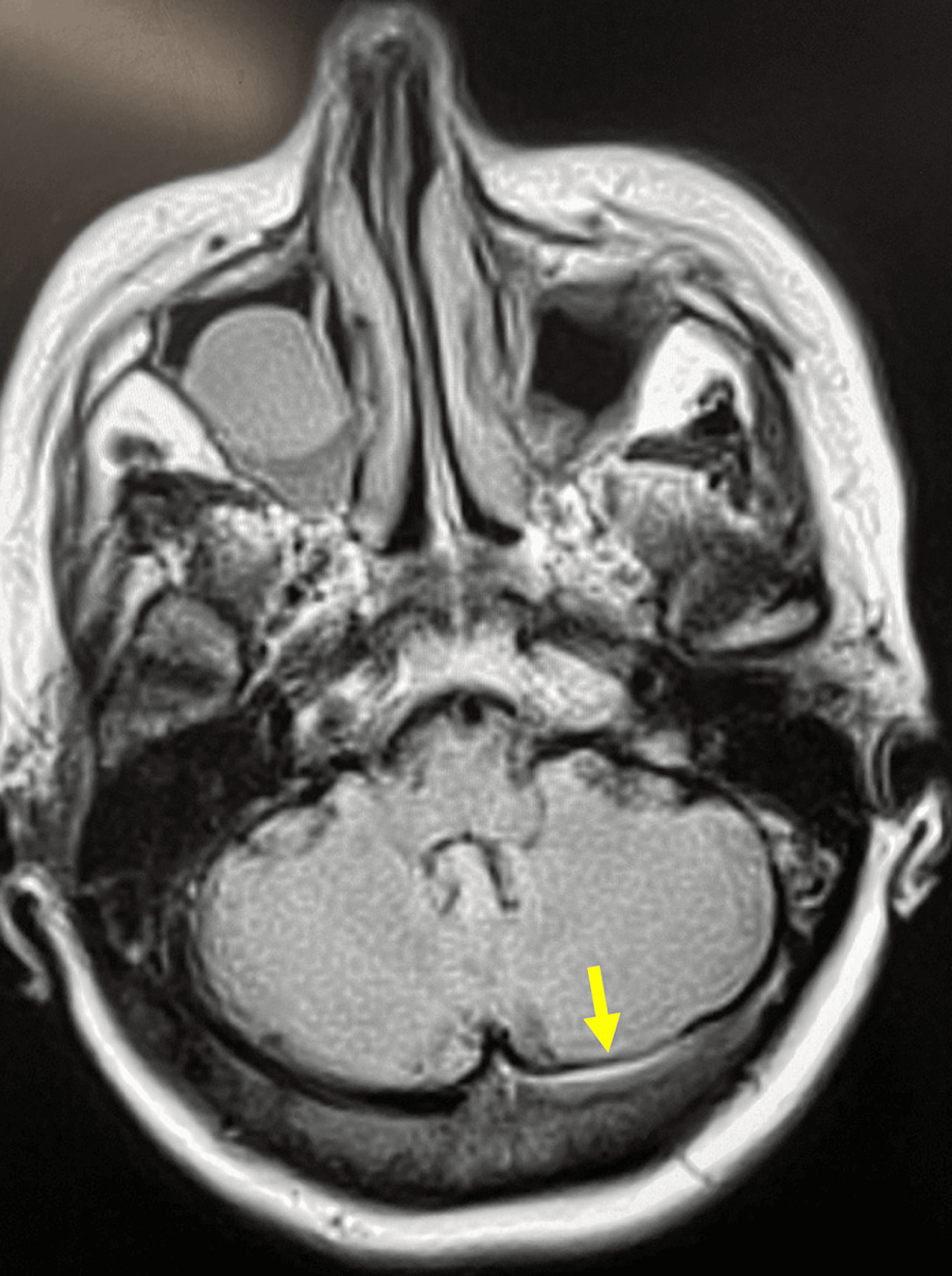 Cureus Cerebral Venous Sinus Thrombosis Complicating Herpes Zoster Ophthalmicus Ophthalmoplegia