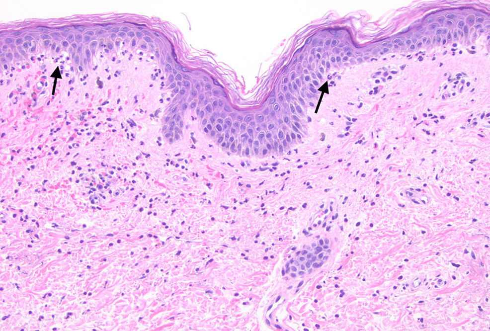 Cureus Bullous Systemic Lupus Erythematosus A Case Report