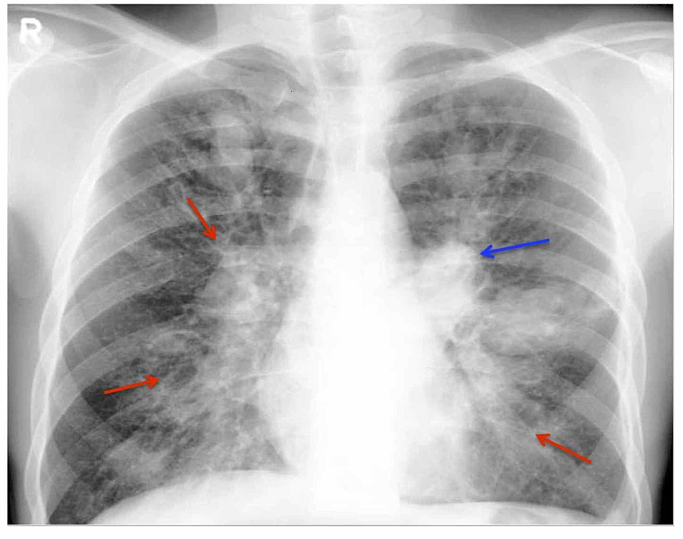 Cureus | Diagnosing Allergic Bronchopulmonary Aspergillosis: A Review