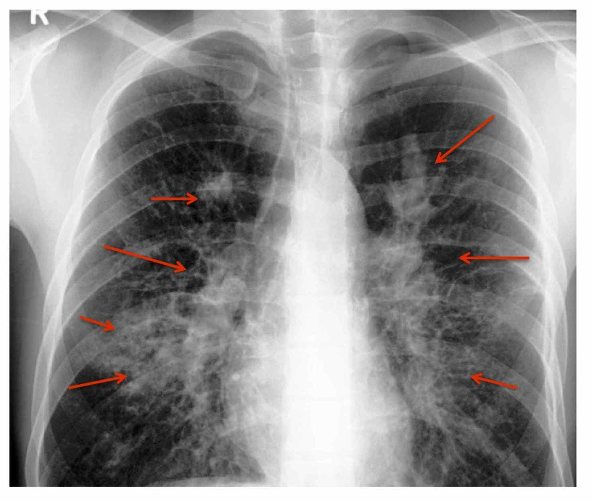 Cureus | Diagnosing Allergic Bronchopulmonary Aspergillosis: A Review