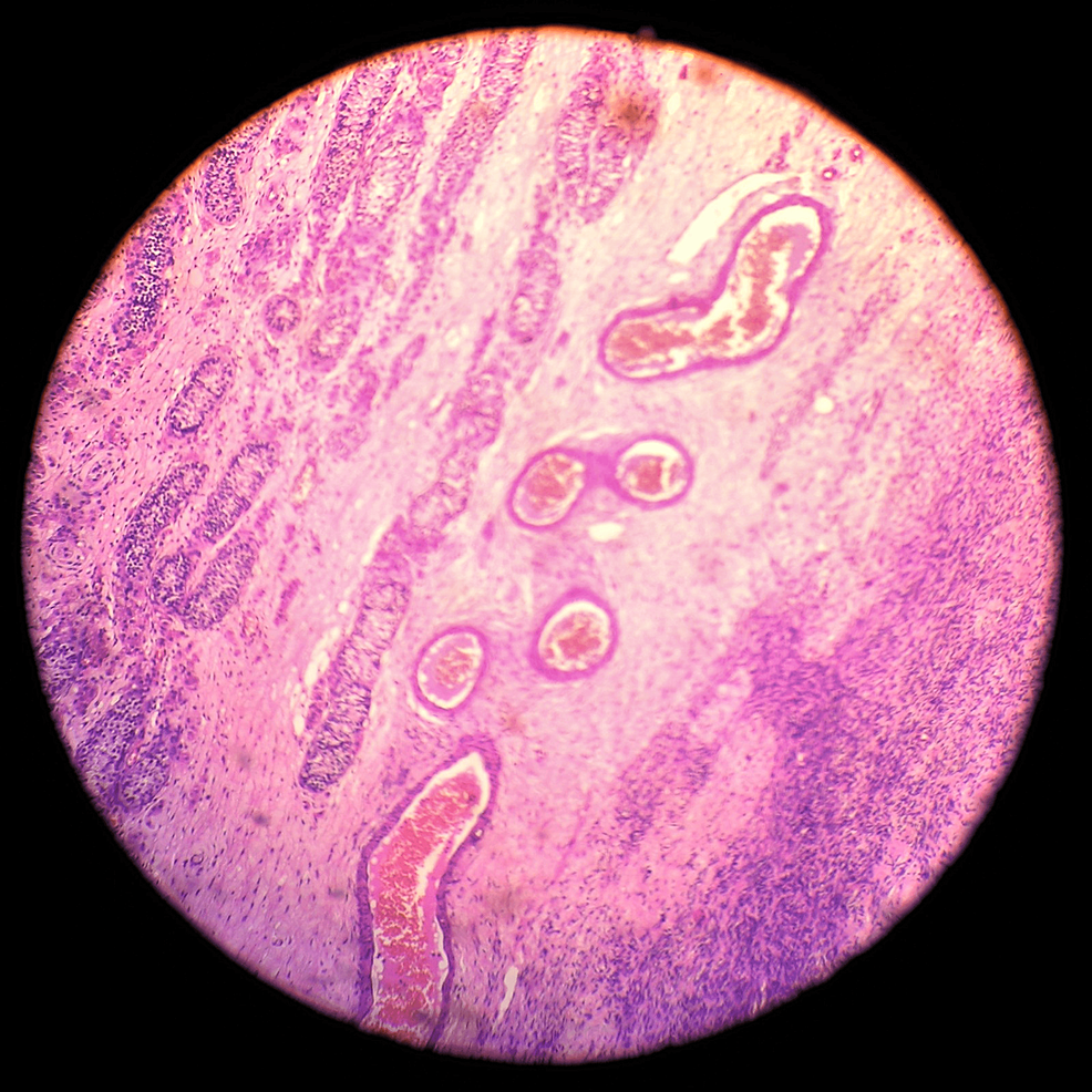 Cureus Total Vaginectomy in a True Hermaphrodite A Case Report