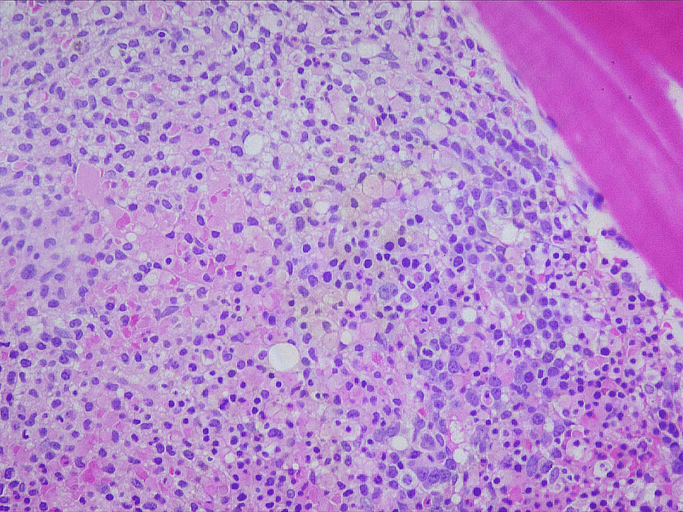 Cureus Hairy Cell Leukemia Hepatic Affinity Status Post Splenectomy
