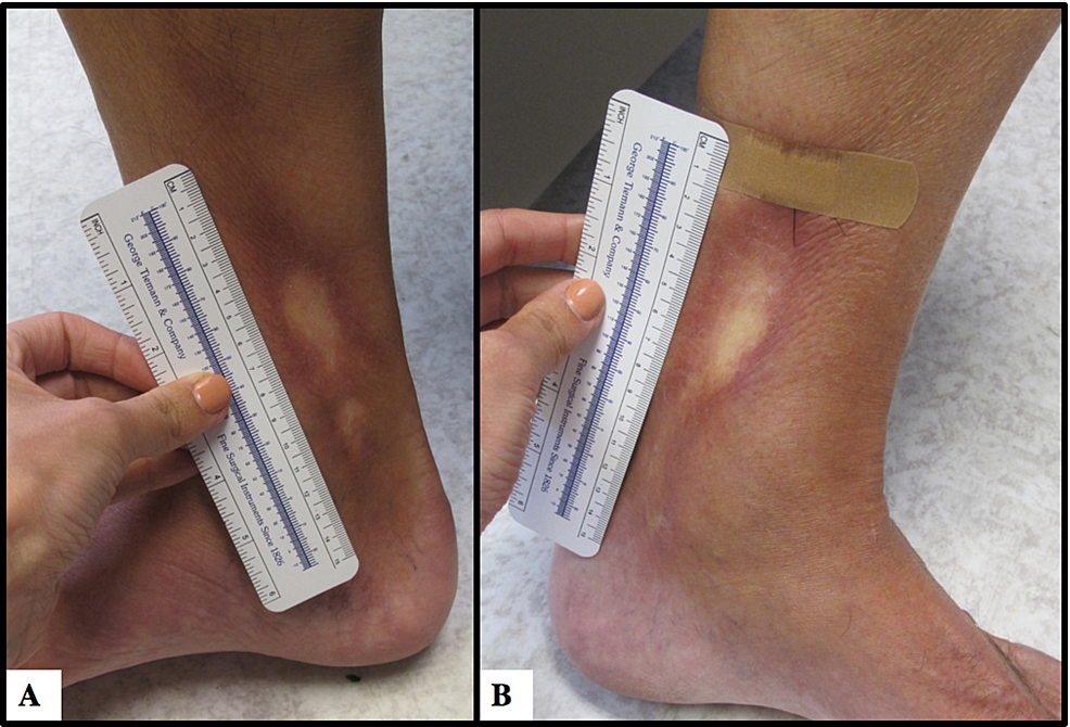 Cutaneous Chronic Graft Versus Host Disease in a Symmetric Distribution ...