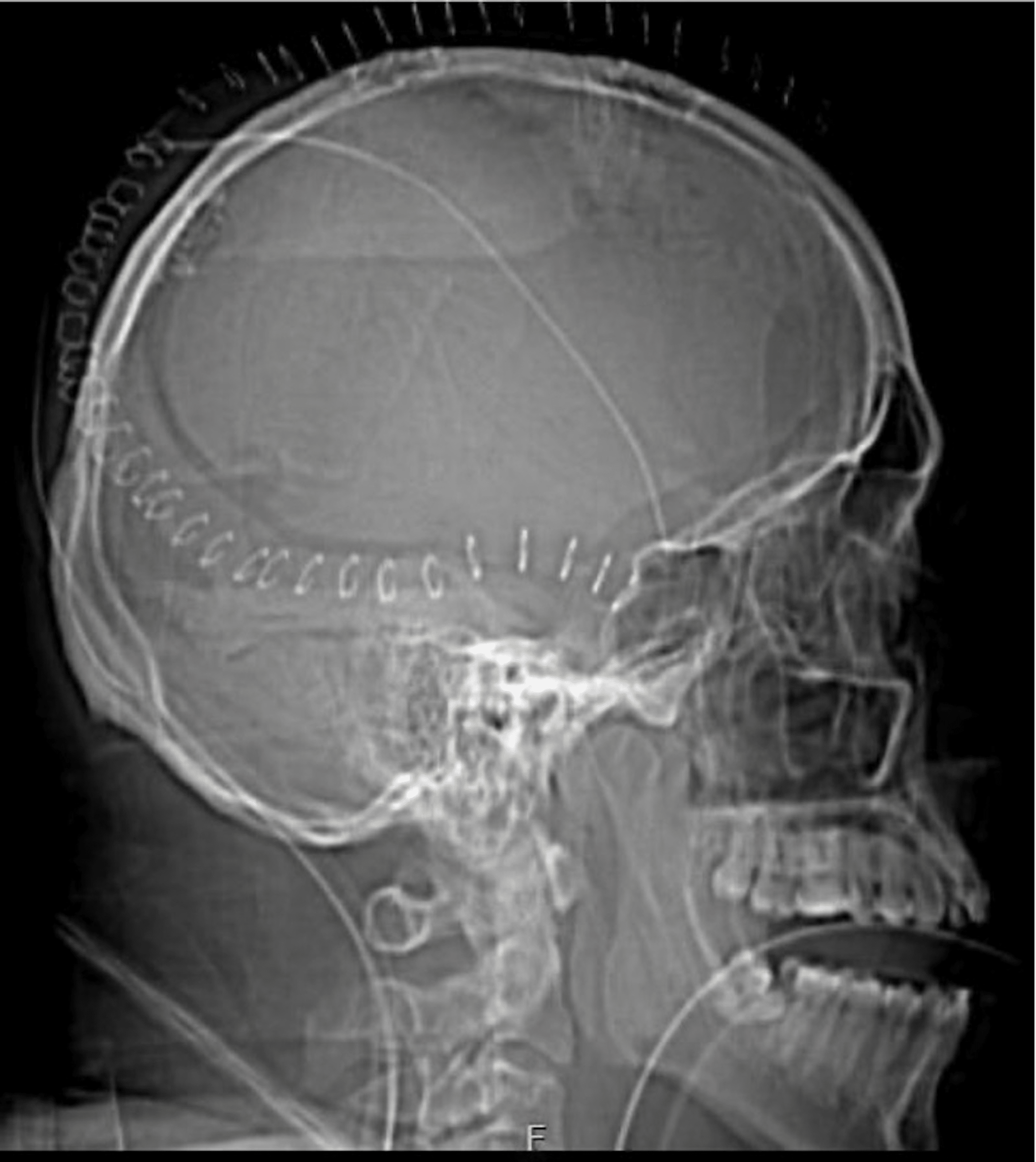 Cureus | Technical Optimization of Decompressive Craniectomy for ...