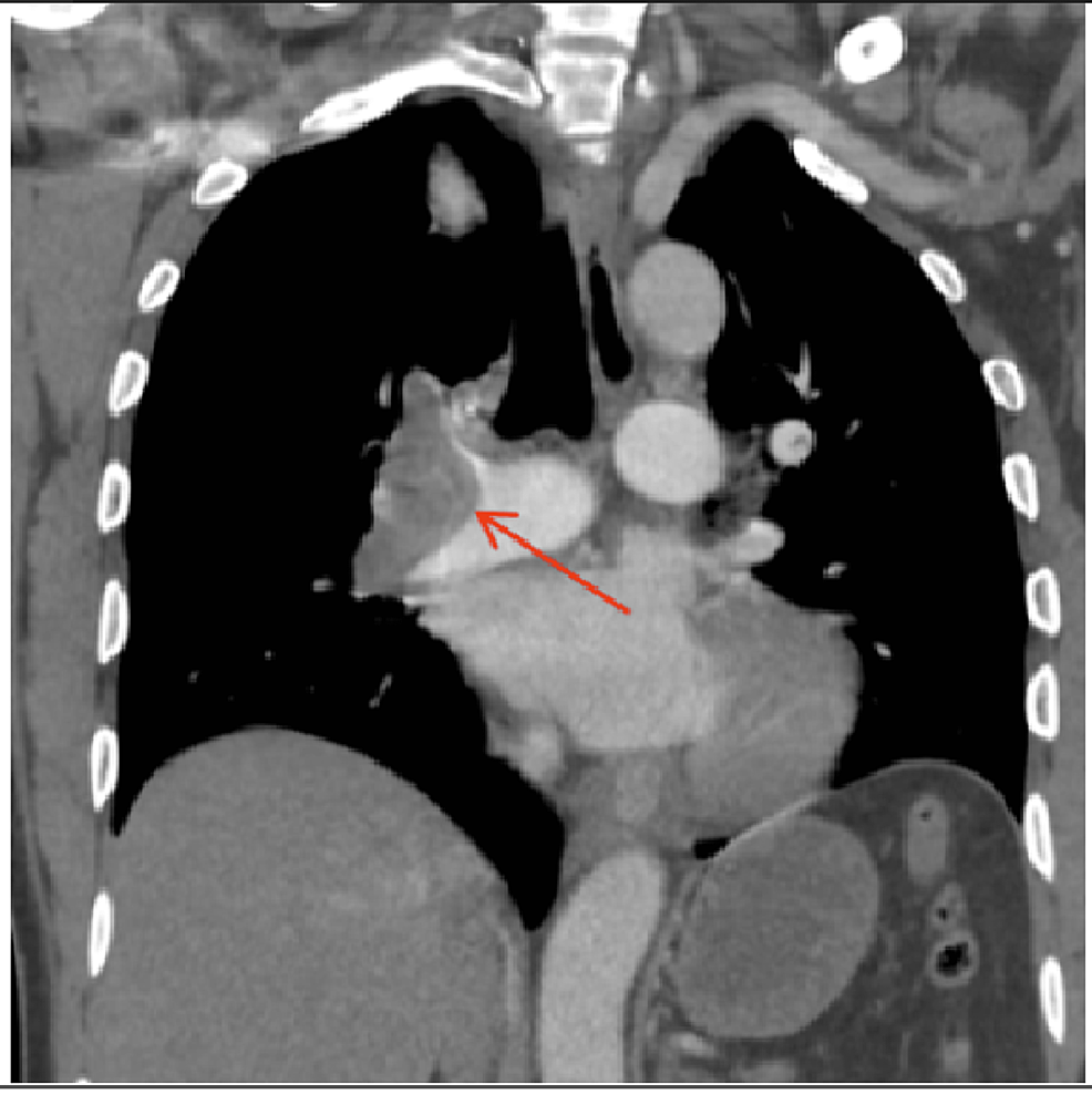 Un rapport de cas de thromboses disséminées et d’ischémie cardiaque chez un patient atteint de pneumonie au COVID-19
