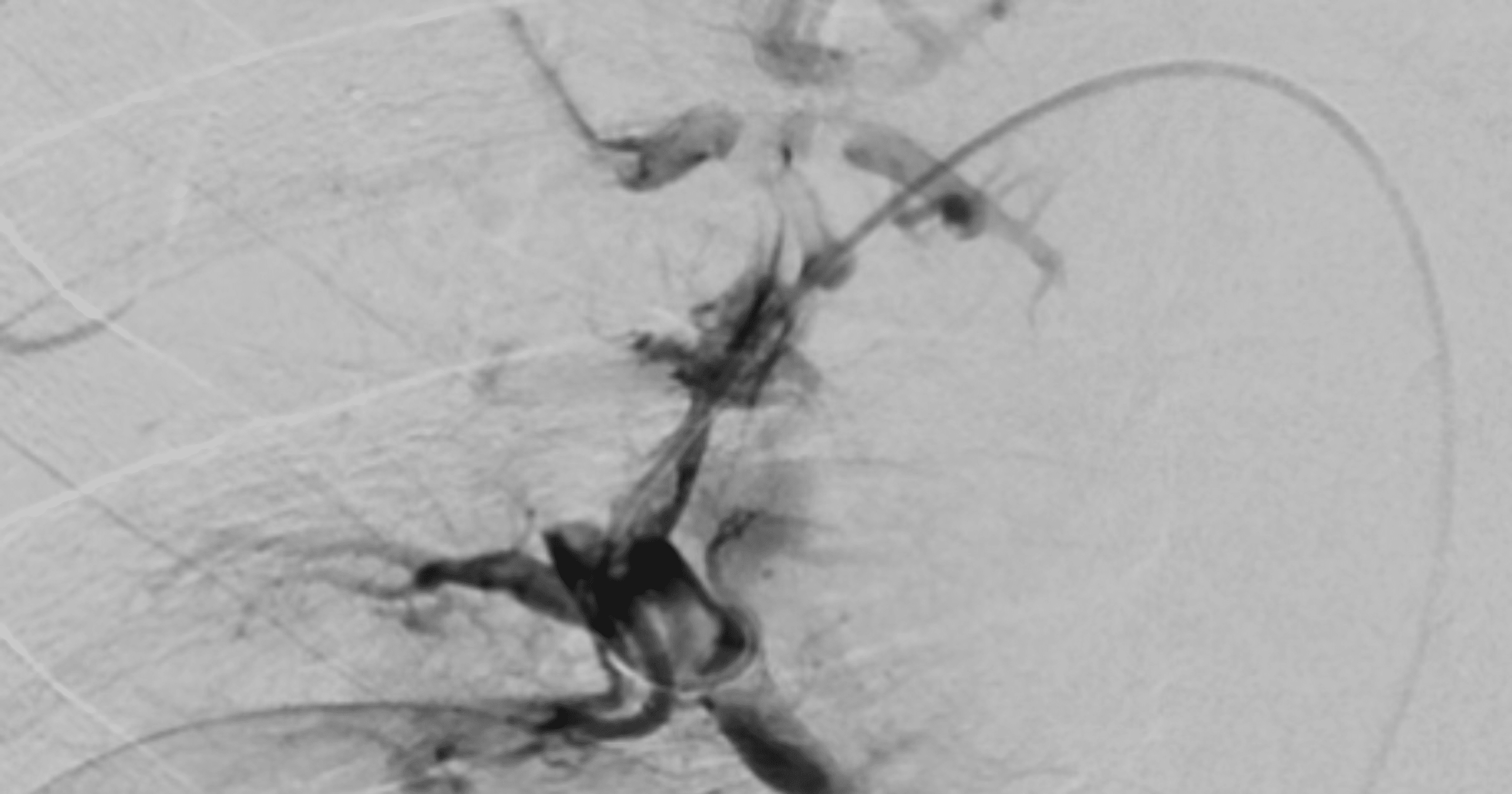 Cureus A Case Report of Disseminated Thromboses and Cardiac Ischemia