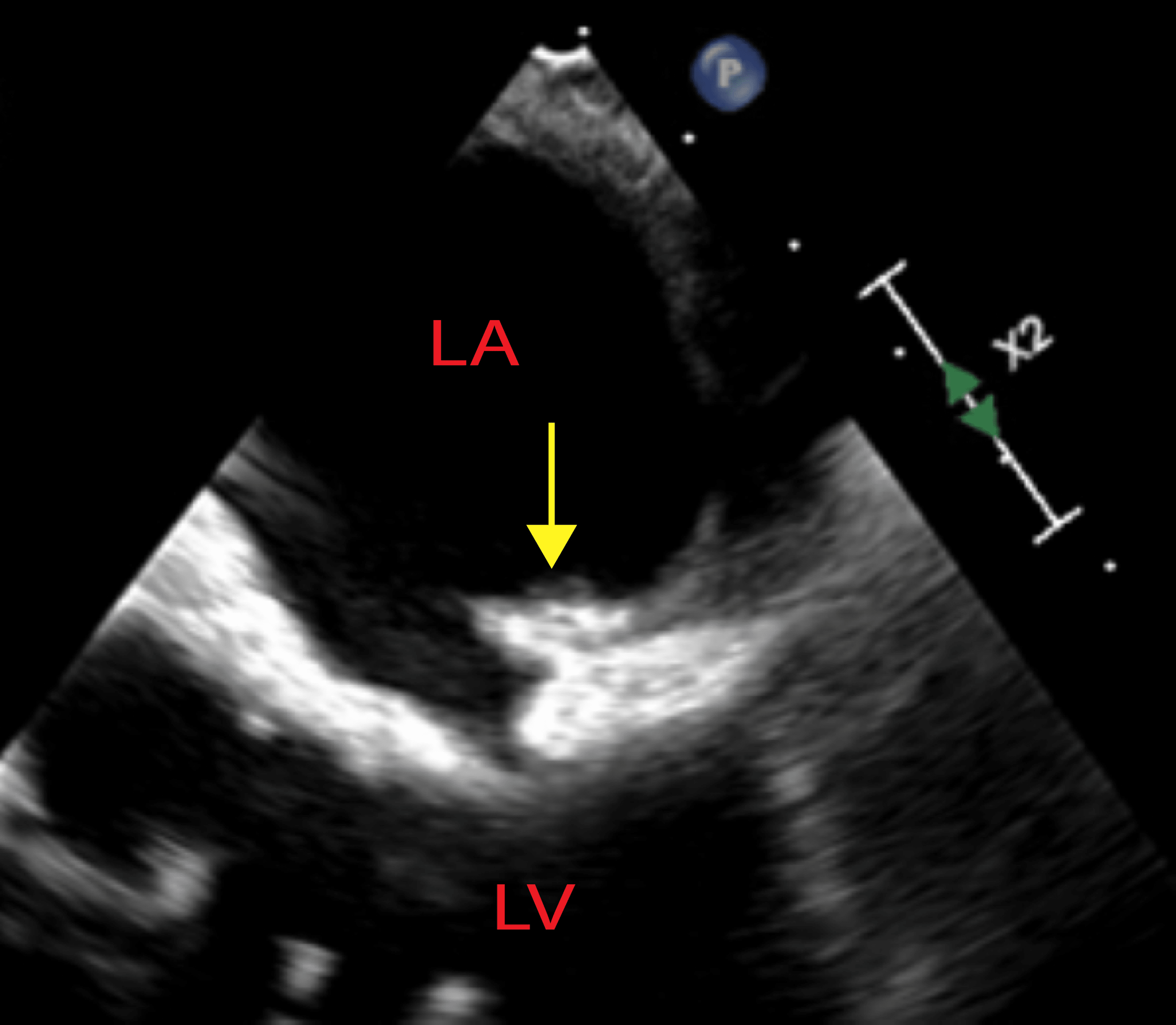 Cureus Commensal Streptococcal Infective Endocarditis of the Native