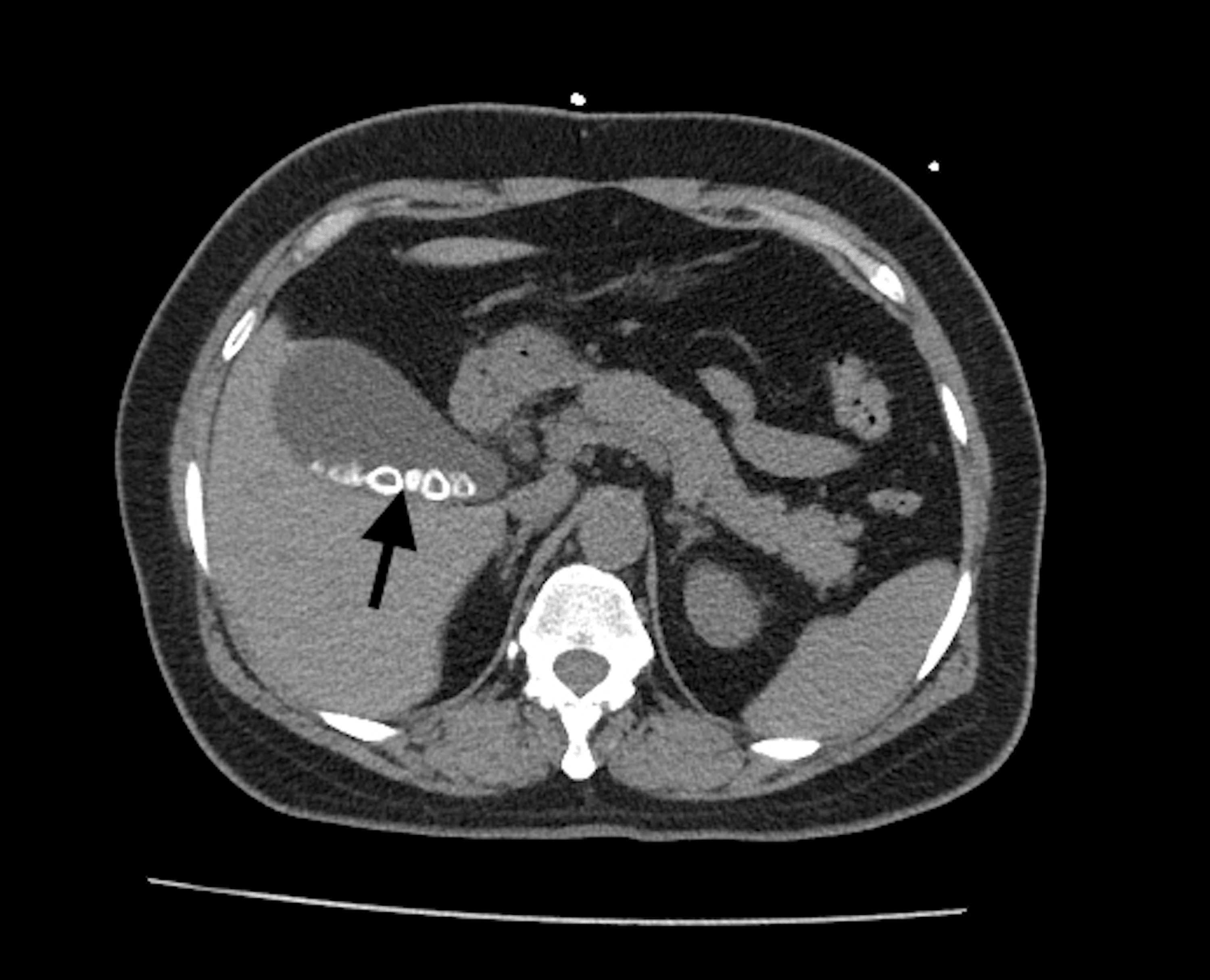 Acute Cholecystitis Presenting With Atypical Radiologic or Laboratory