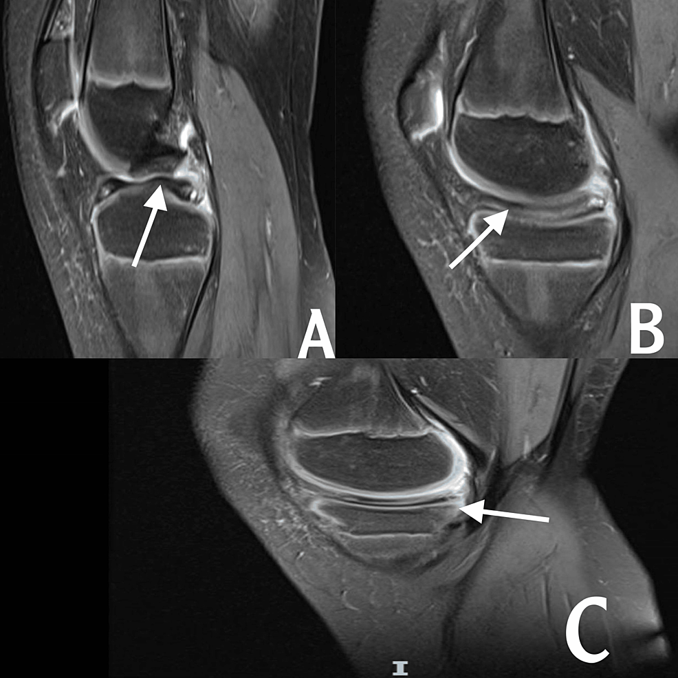 Medial Discoid Meniscus: A Rare Case Report | Cureus