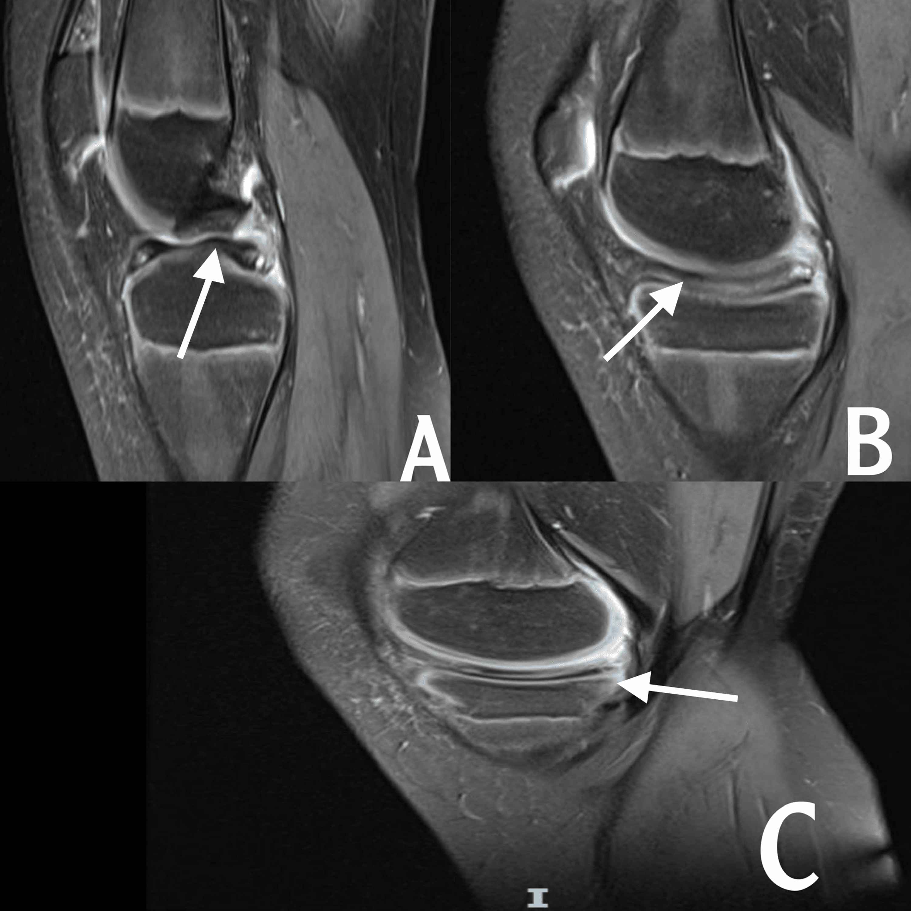 Cureus | Medial Discoid Meniscus: A Rare Case Report