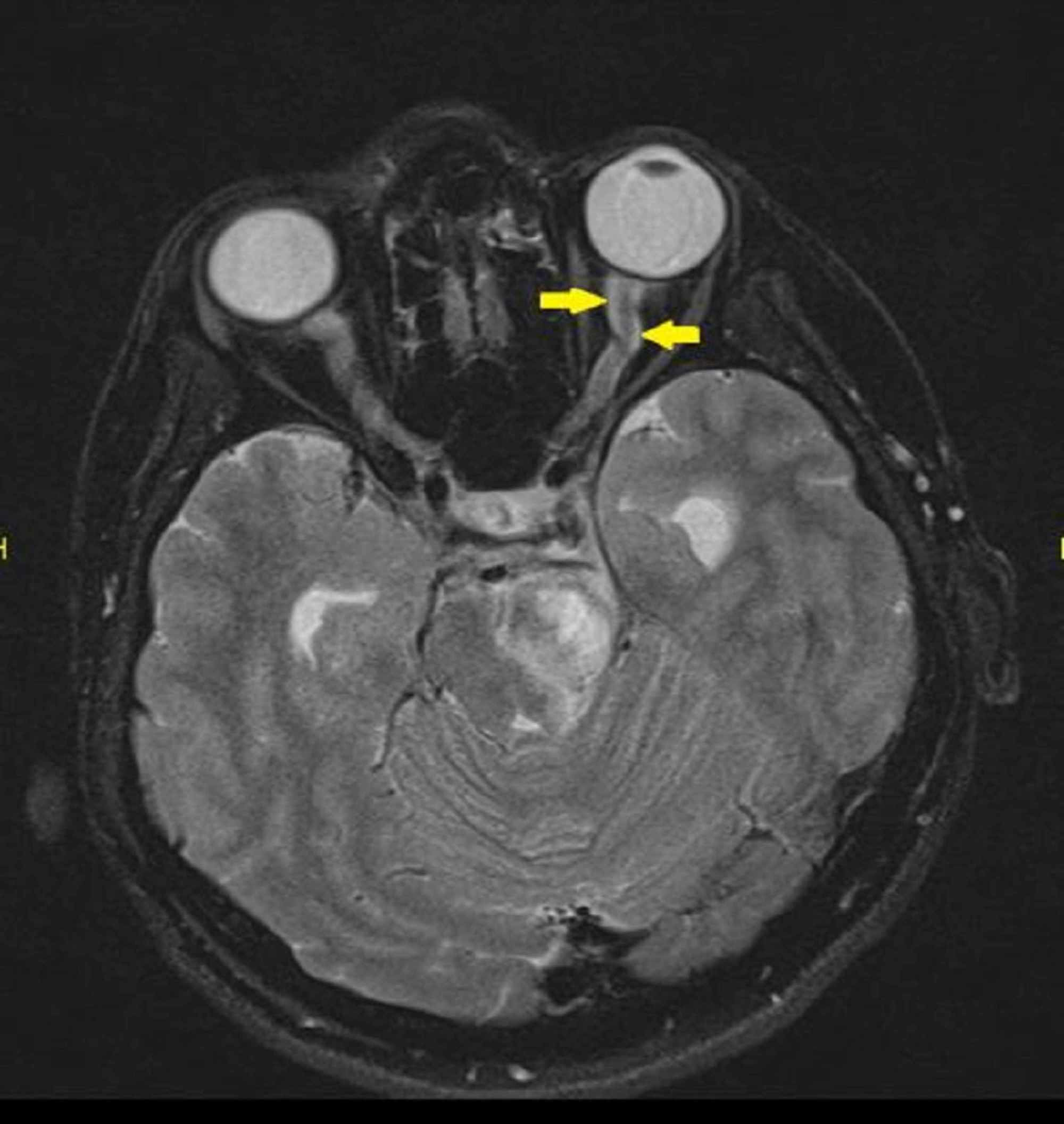 Optic Nerve Lesion Mri My XXX Hot Girl