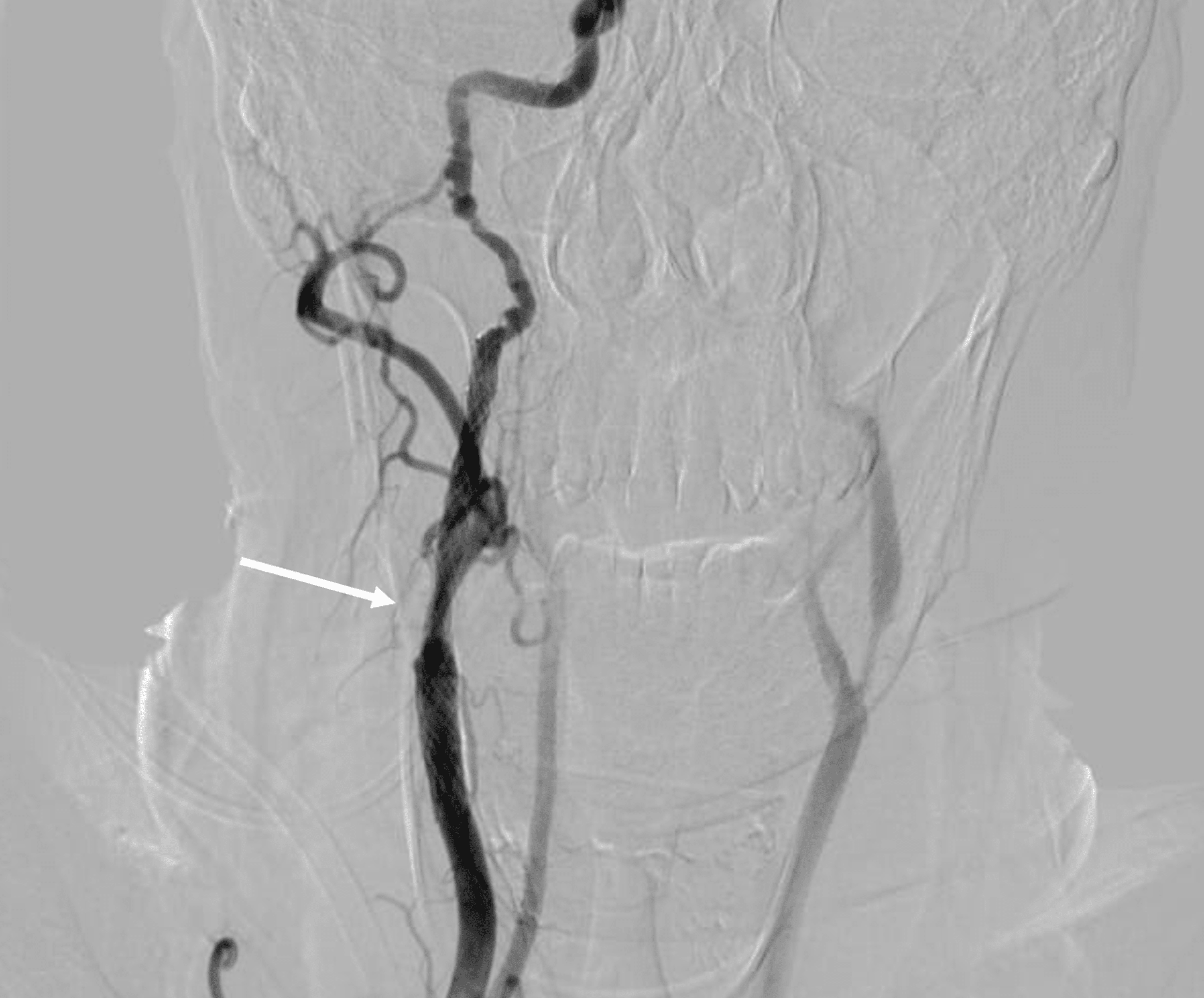 Hand Knob Syndrome Secondary to Ipsilateral Carotid Fibromuscular Dysplasia and