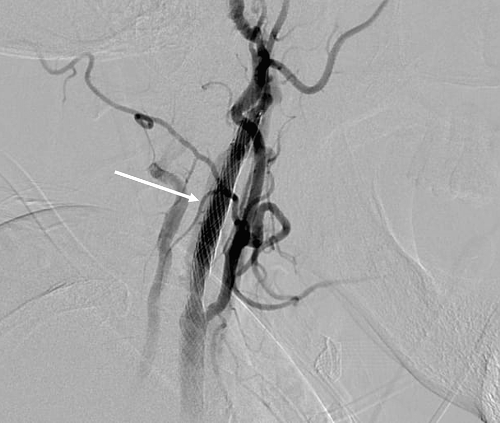 Hand Knob Syndrome Secondary to Ipsilateral Carotid Fibromuscular Dysplasia and