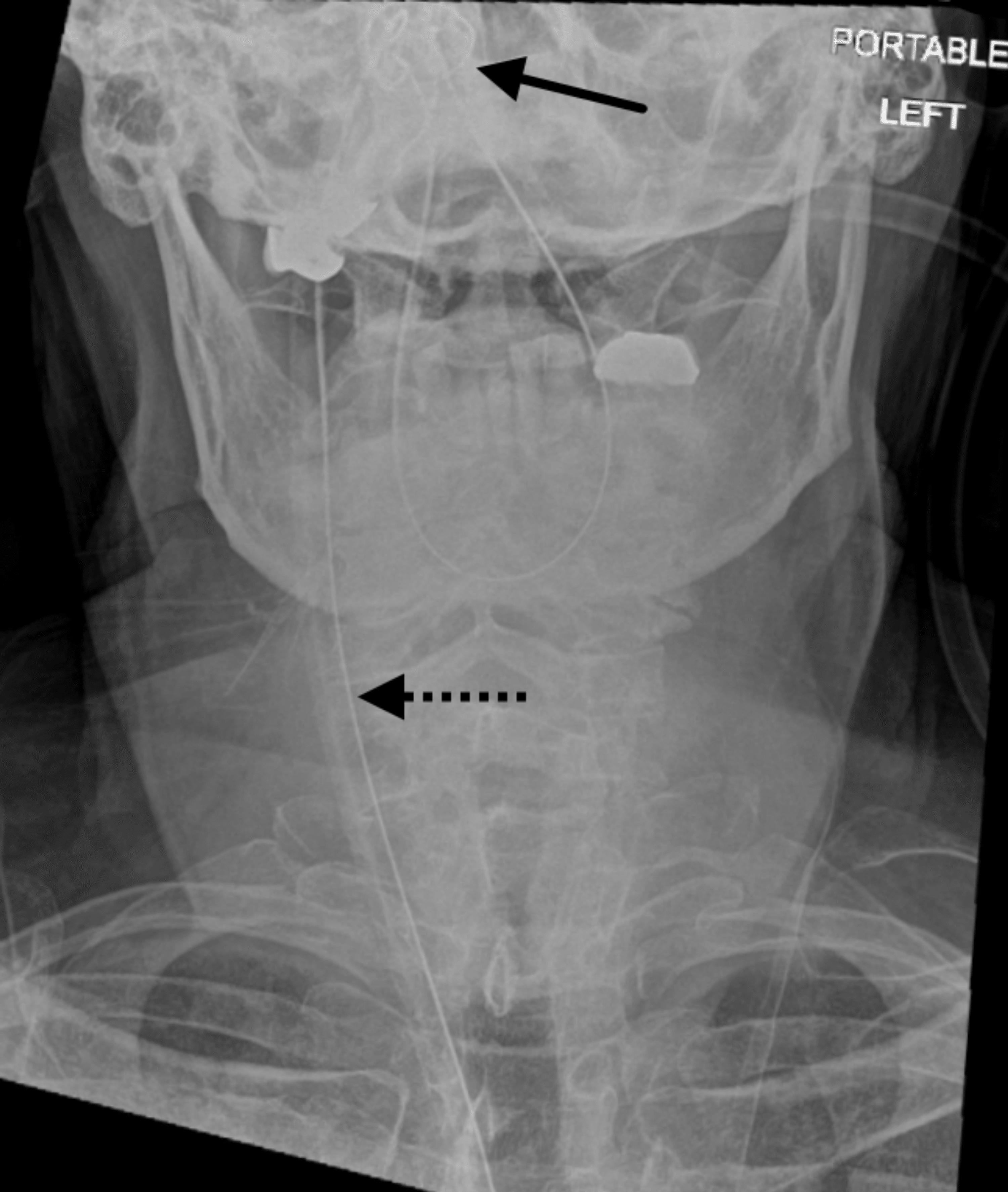 Cureus Knotted Nasogastric Tube Removed With a Bronchoscope