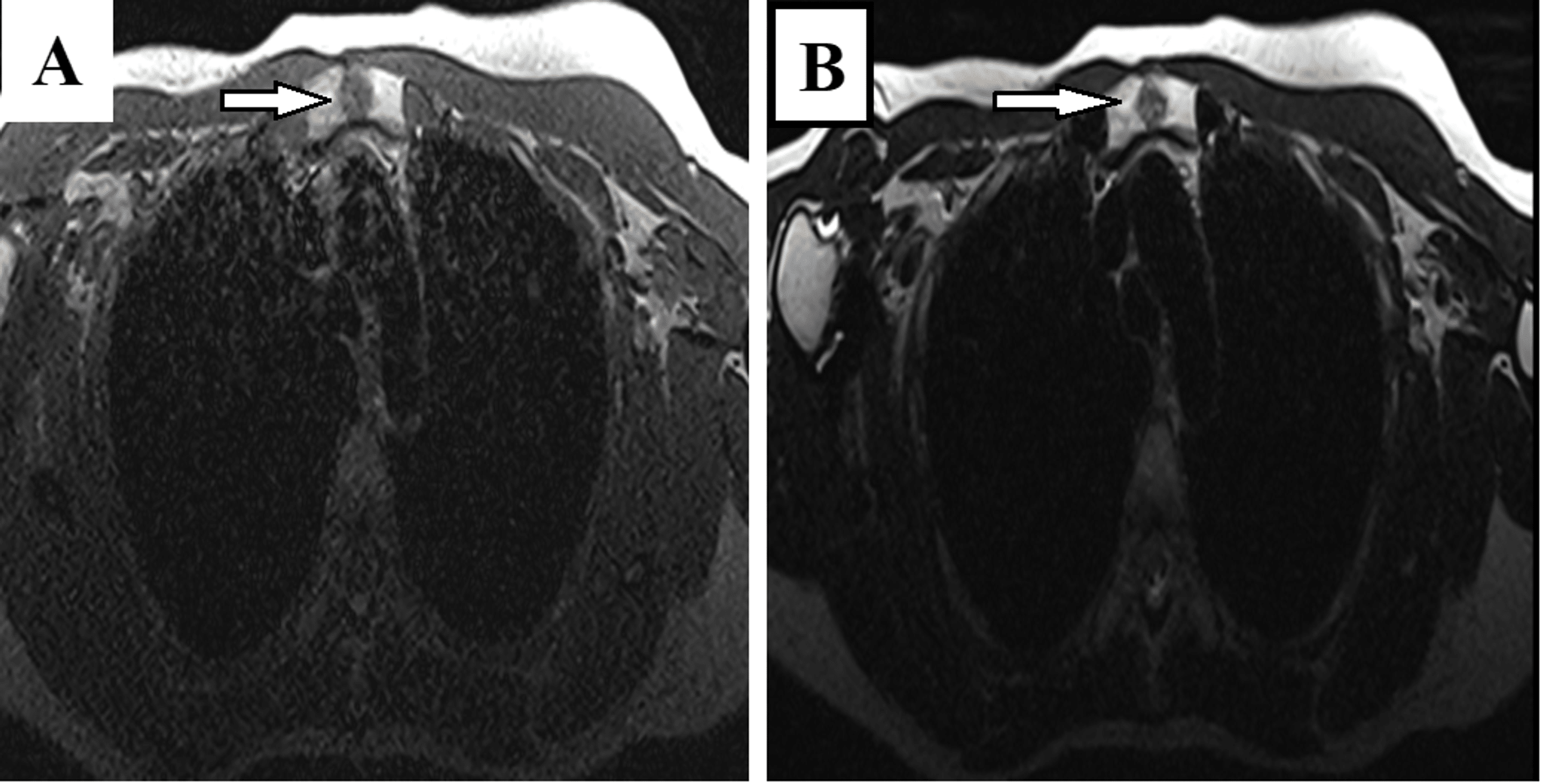 Cureus Intraosseous Hibernoma A Rare Entity In Orthopedics With