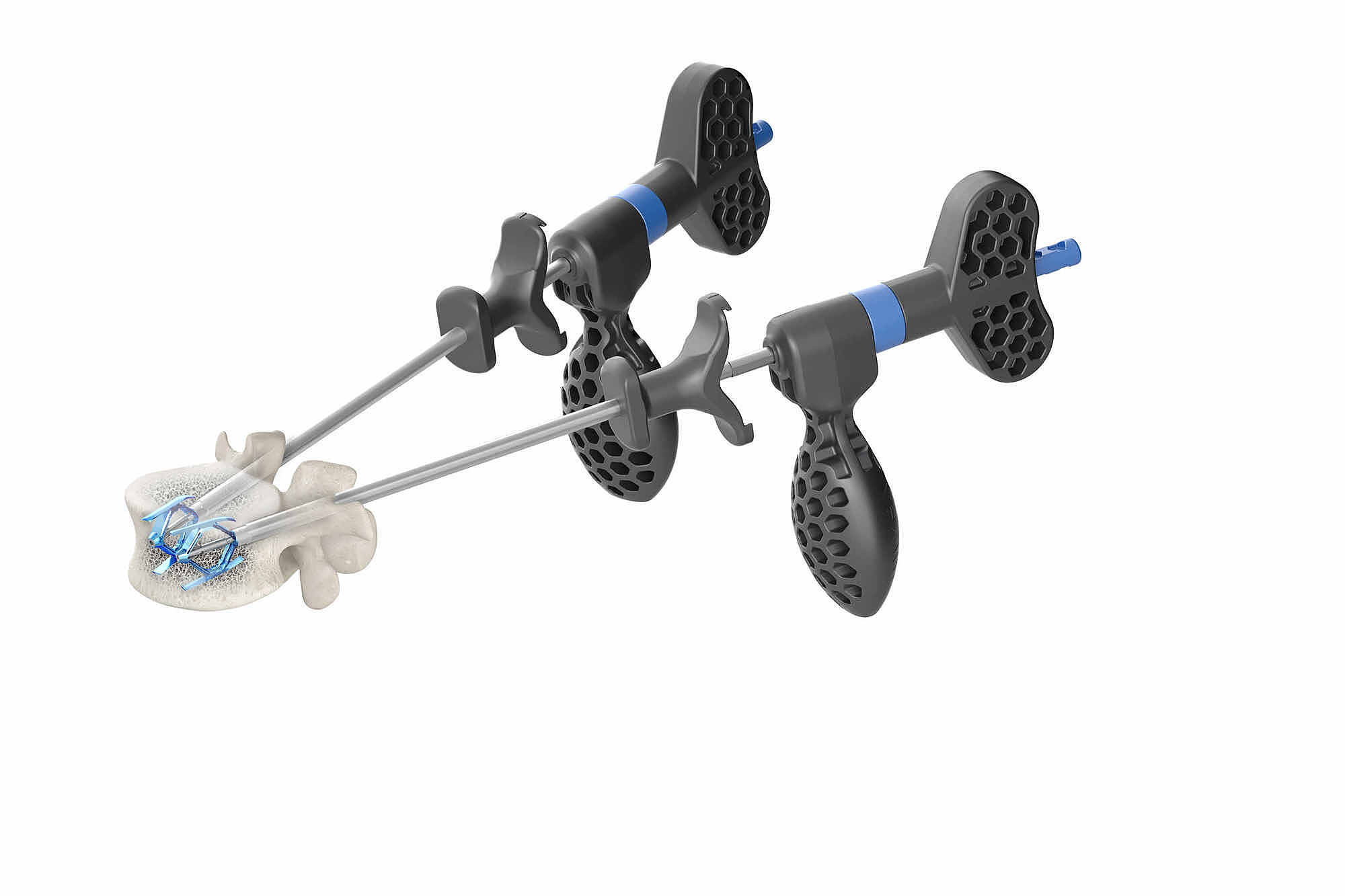 Cureus Treatment of a Highrisk Thoracolumbar Compression Fracture