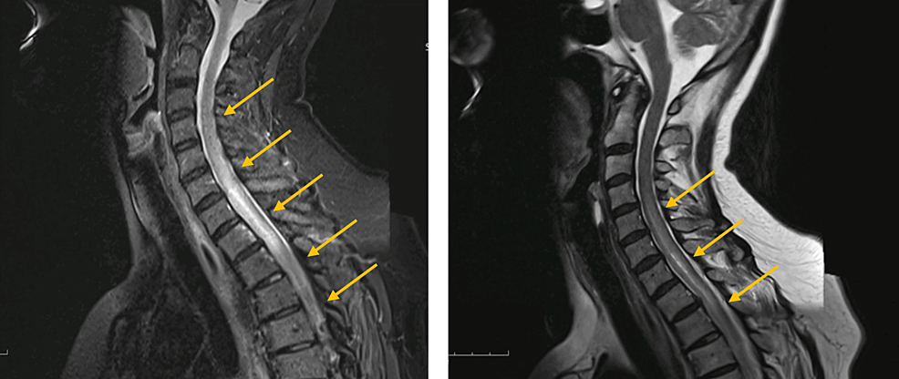 Can Failed Back Surgery Syndrome Be Healed by Transverse Myelitis? | Cureus