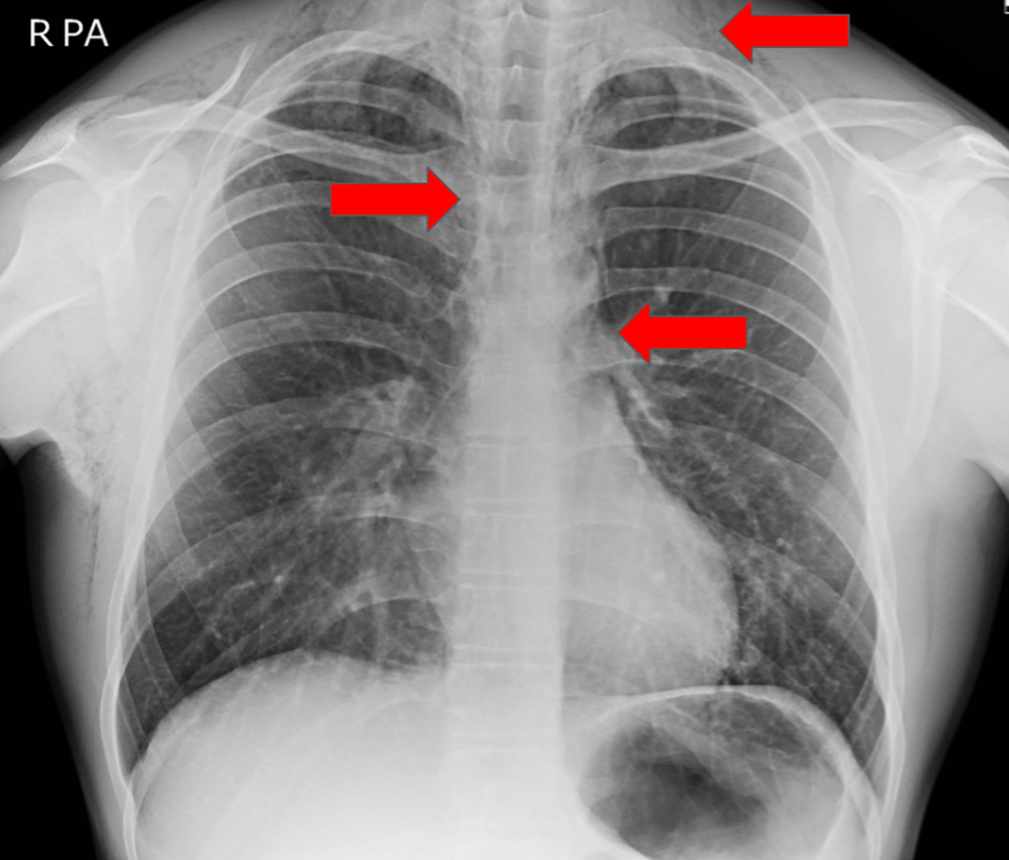 Cureus | Left-sided Neck Swelling: An Unusual Presentation of a Rare ...