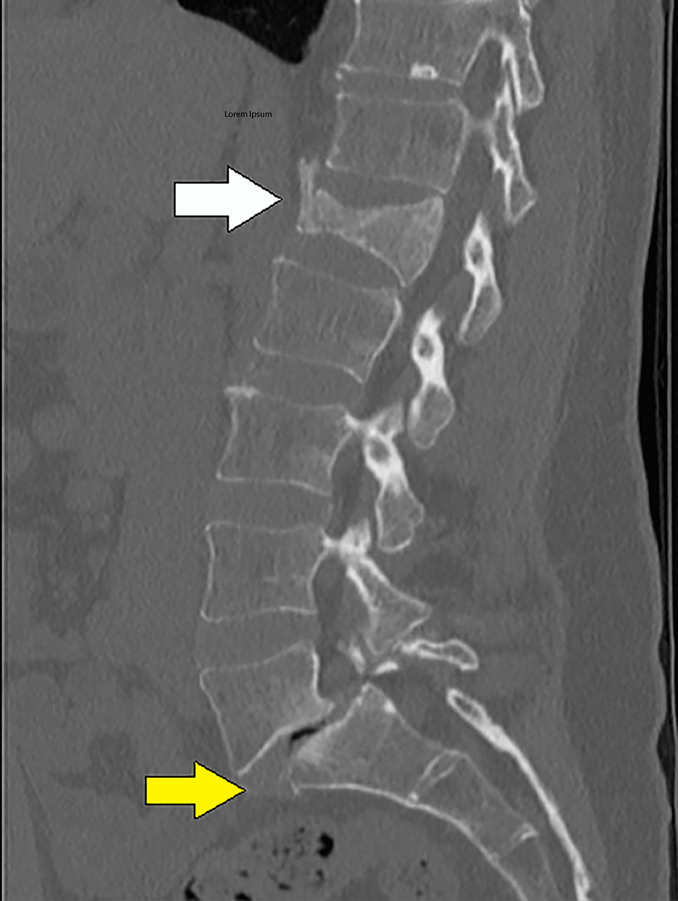 Bilateral hip DXA scan image from a 59-year-old post-menopausal woman.