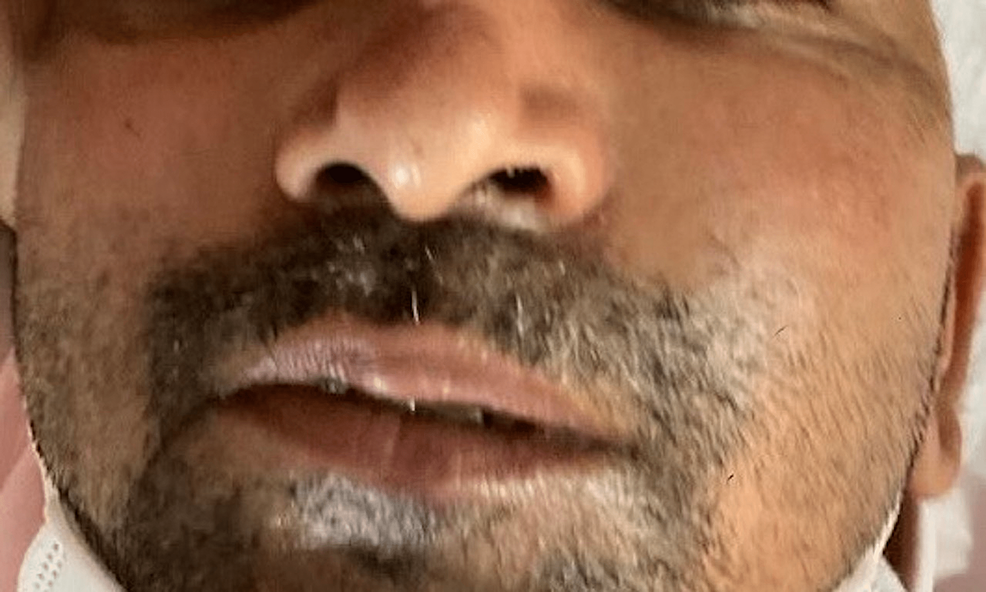 Orbital Mucormycosis Understanding the Deadly Fungus Sweeping the