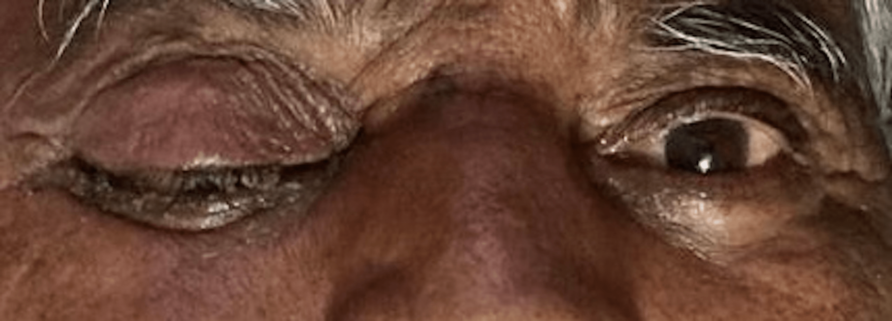 Cureus Orbital Mucormycosis Understanding the Deadly Fungus Sweeping