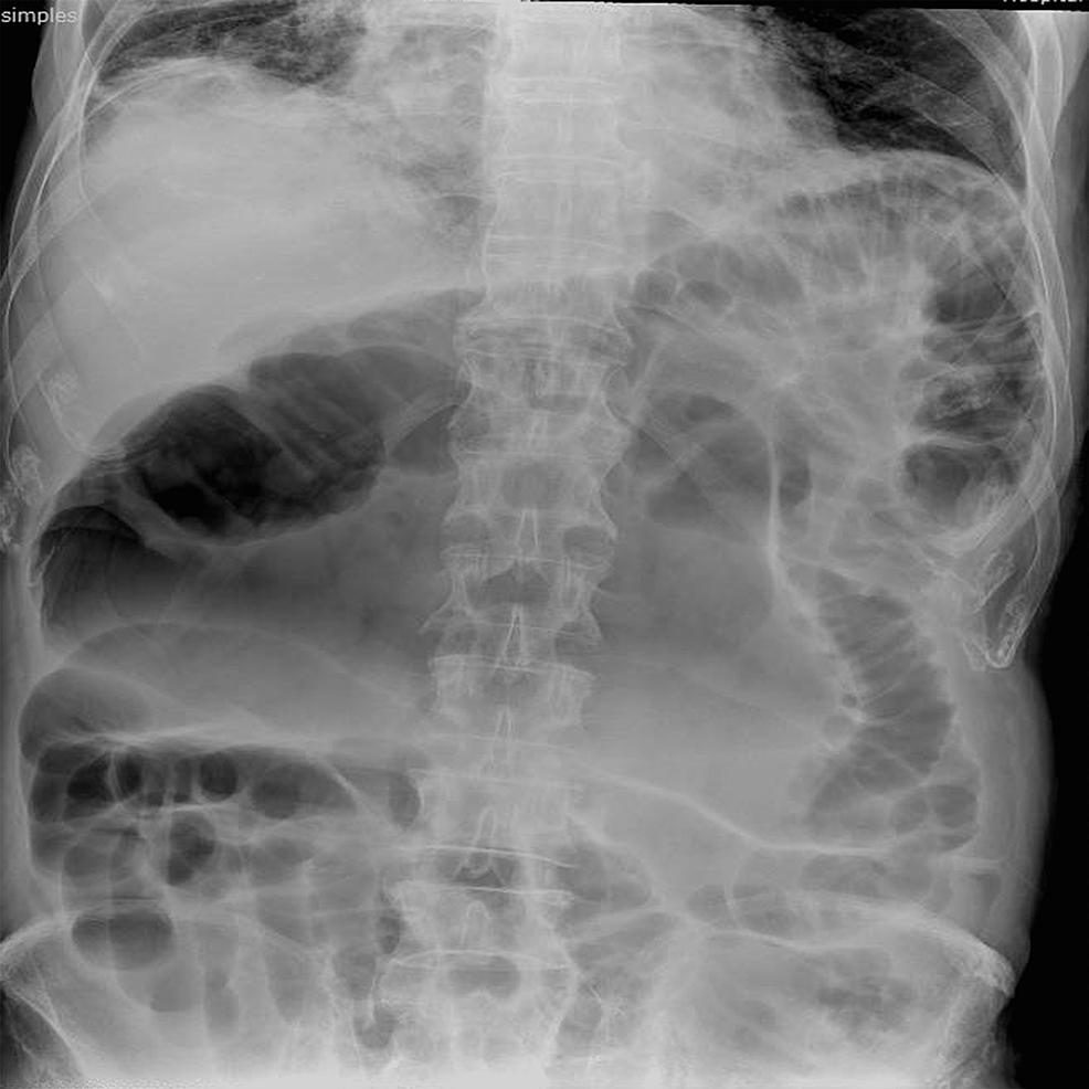 Cureus Adult Colocolic Intussusception A Rare Case Of Intestinal Obstruction 4679