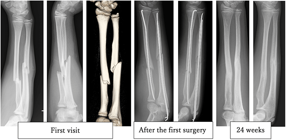 Frontiers | Determination of intramedullary nail based on centerline  adaptive registration