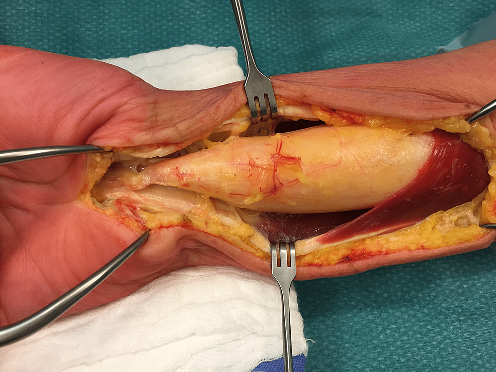 lipo b vs lipo c reddit Intraneural Lipoma: A Rare Cause of Median Nerve Compression Size:2 Bottles lipilab GHK-Cu Copper Peptide 50