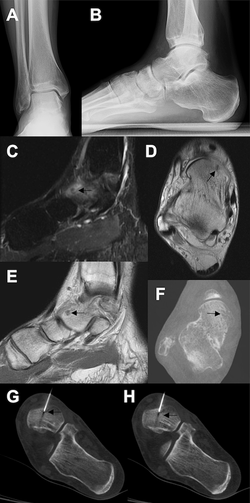 Cureus Osteoid Osteomas of the Talus A Case Report of Four Patients