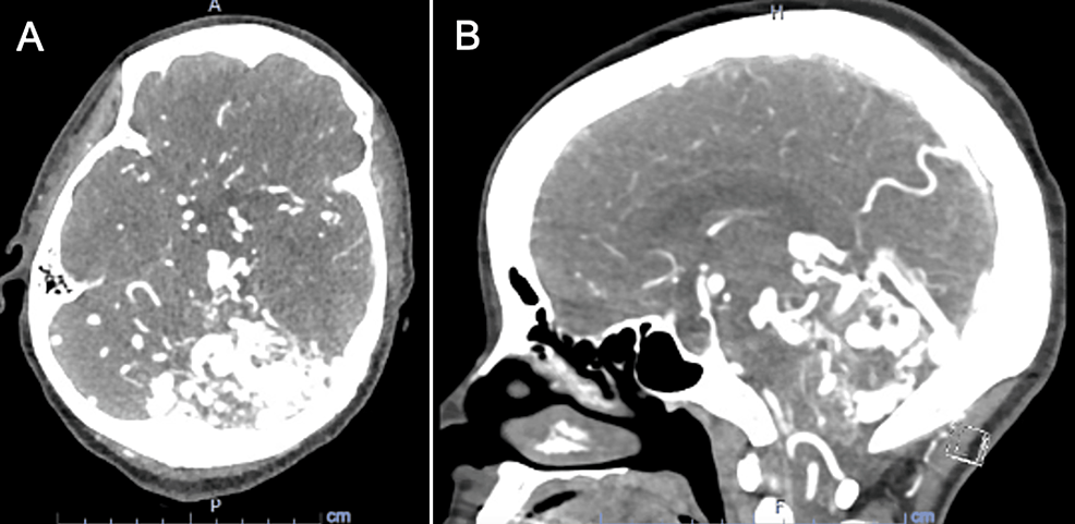 Posterior inferior cerebellar artery, Radiology Reference Article