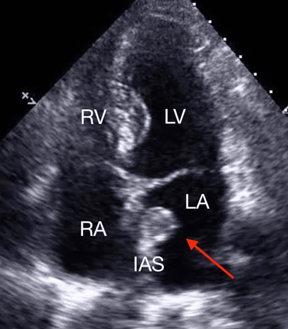 Cureus | Faint of Heart: A Case of Atrial Myxoma Presenting With ...