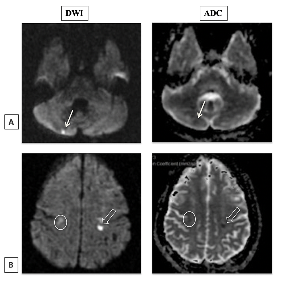 Cureus | Megestrol Acetate Induced Paradoxical Embolism in a Sickle ...