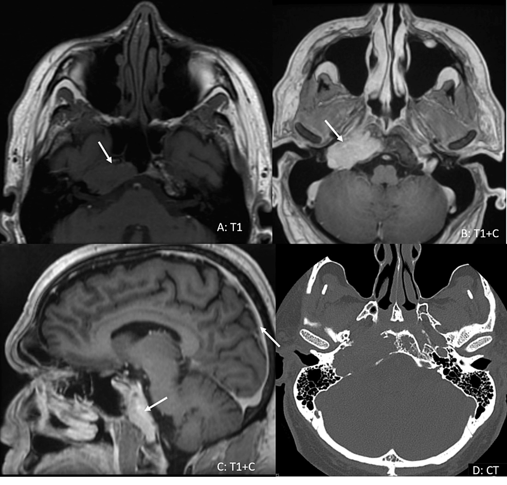 Sixth Nerve Palsy From Multiple Myeloma in Central Nervous