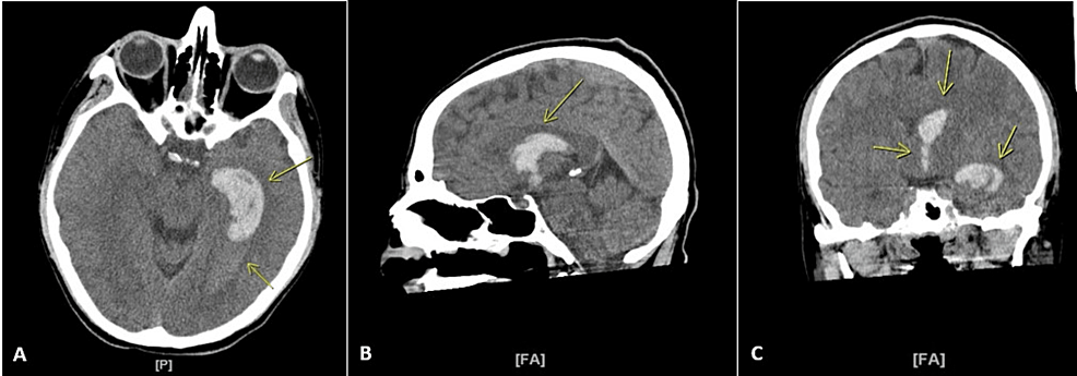 Cureus Intracranial Hemorrhage Secondary to Vaping A Case