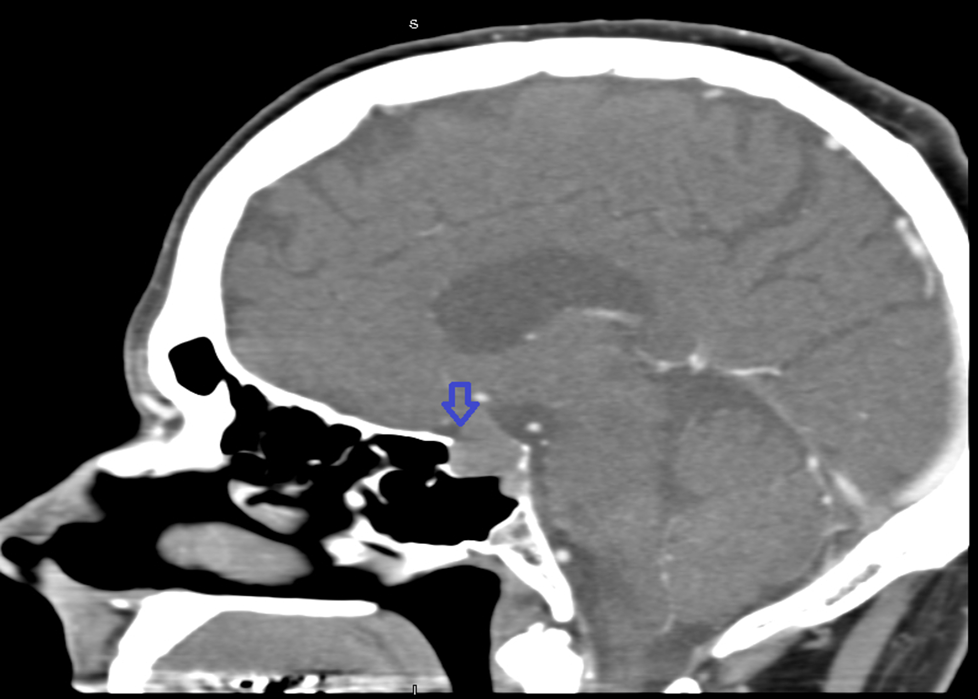 Cureus Tension Pneumocephalus A Rare Complication Of Transsphenoidal Resection Of A Pituitary Macroadenoma