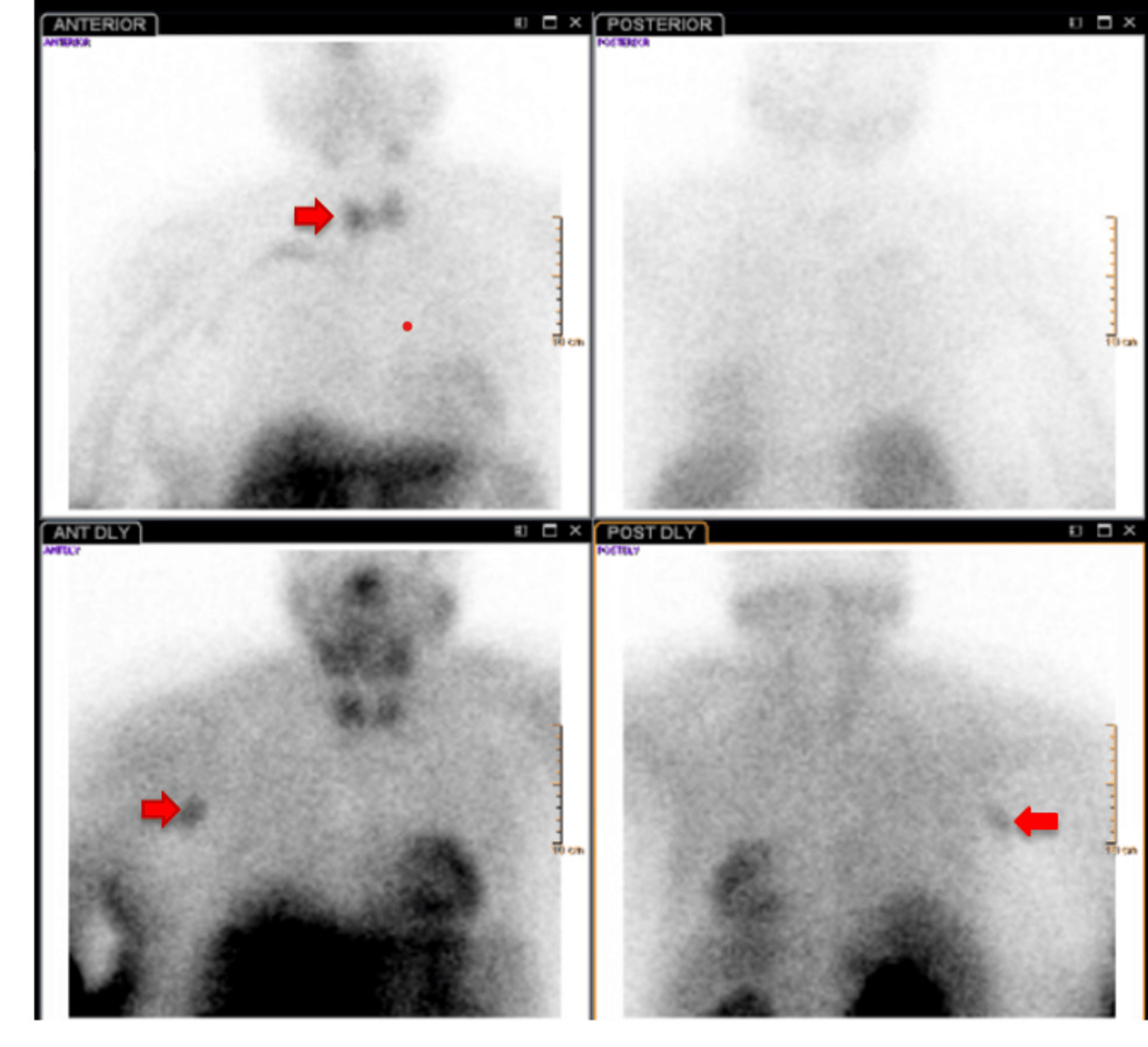 Cureus | Parathyroid Crisis: A Case of Elective Parathyroidectomy