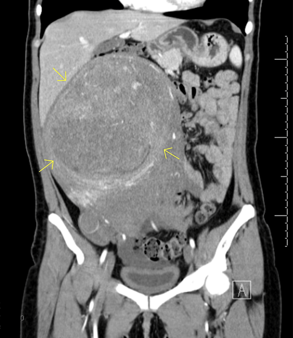 uterine-artery-embolization-in-a-patient-with-large-uterine-fibroids