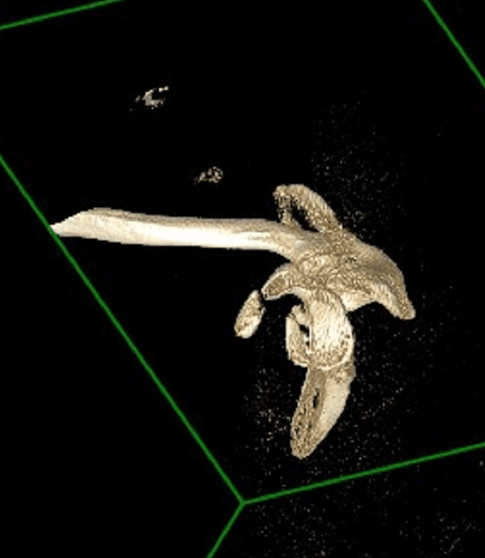 Cureus | A Unique Presentation of the Glenoid, Coracoid, and Proximal ...