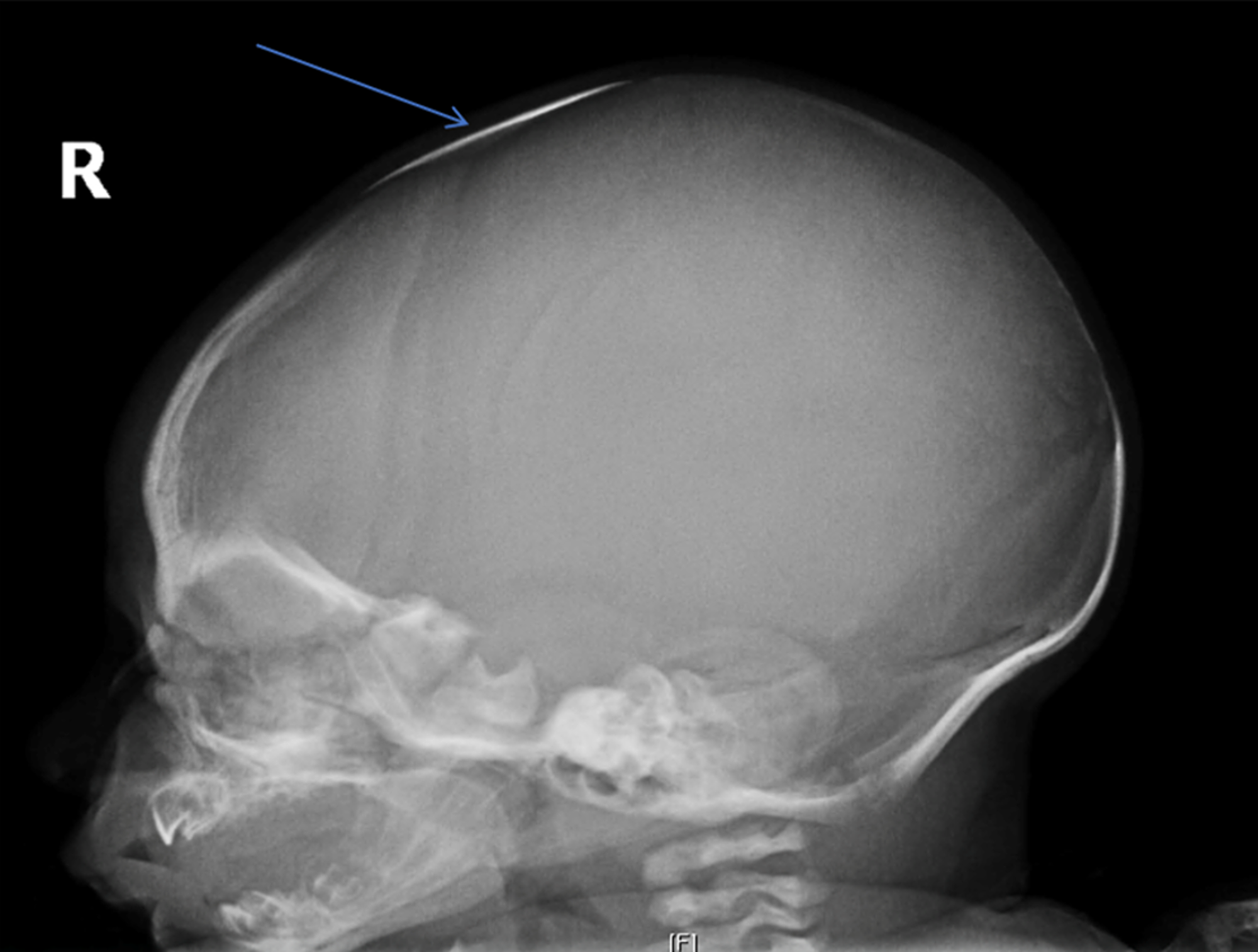 Cureus Wormian Bone in the Anterior Fontanelle of an Otherwise Well