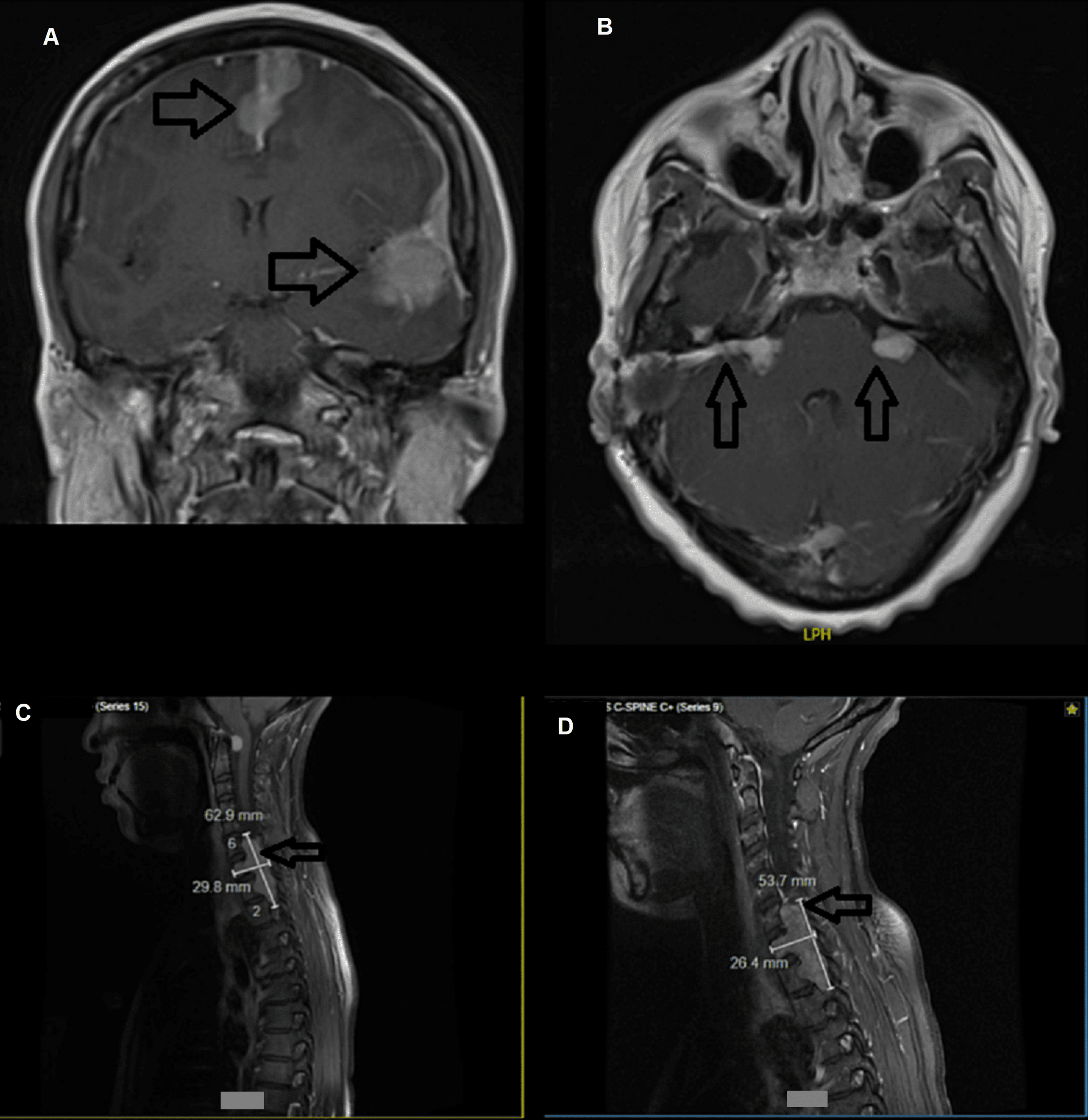Cureus Management of BevacizumabInduced Proteinuria Using an