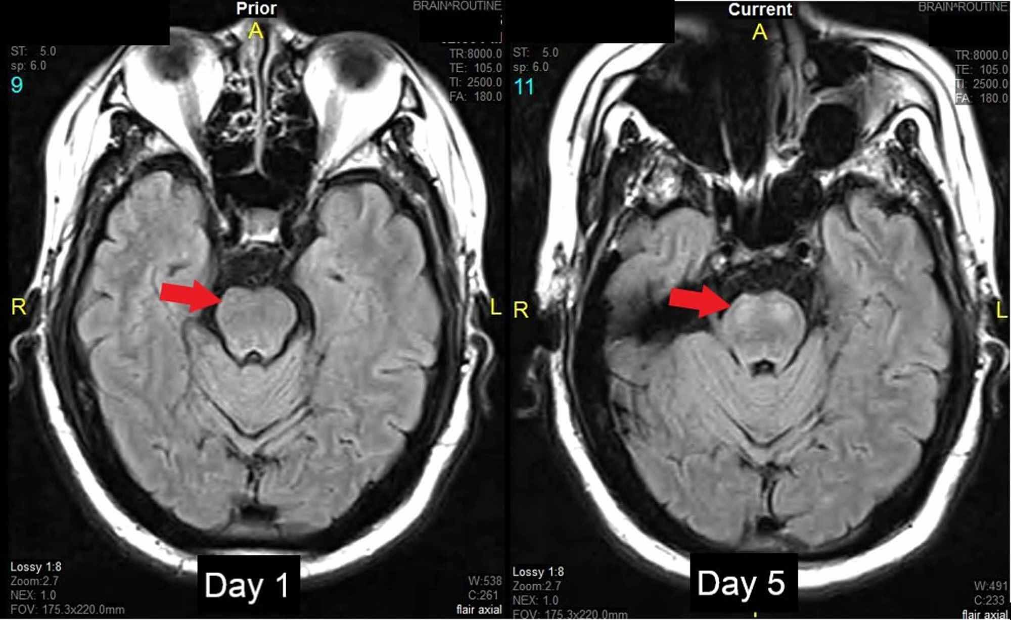 Cureus FalseNegative Initial Resonance Imaging in Acute Posterior Circulation Stroke