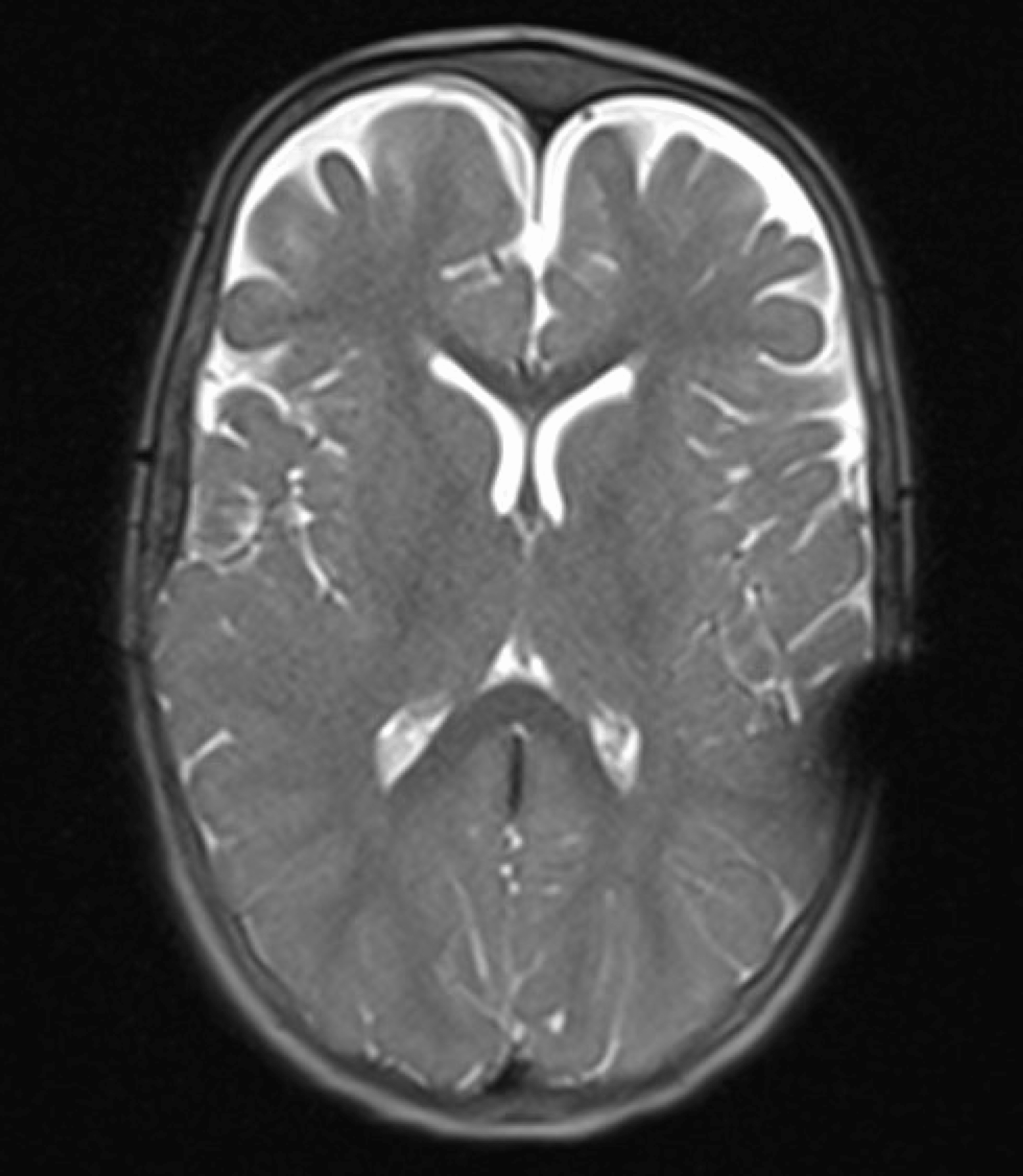 Cureus | A Subdural Hygroma Necessitating a Subdural-Peritoneal Shunt ...