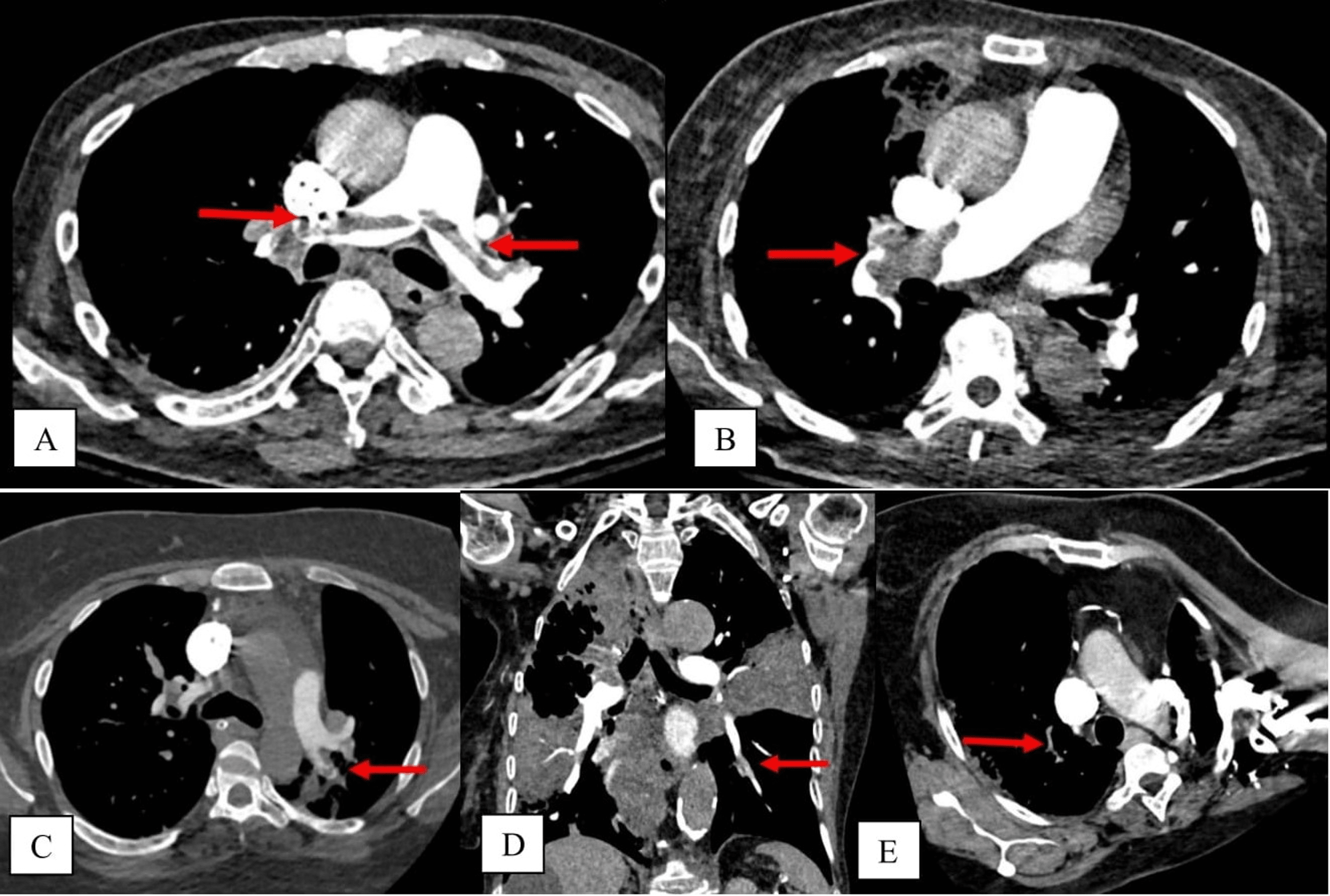Cureus Diagnostic Yield Of Ct Pulmonary Angiogram In The Diagnosis Of