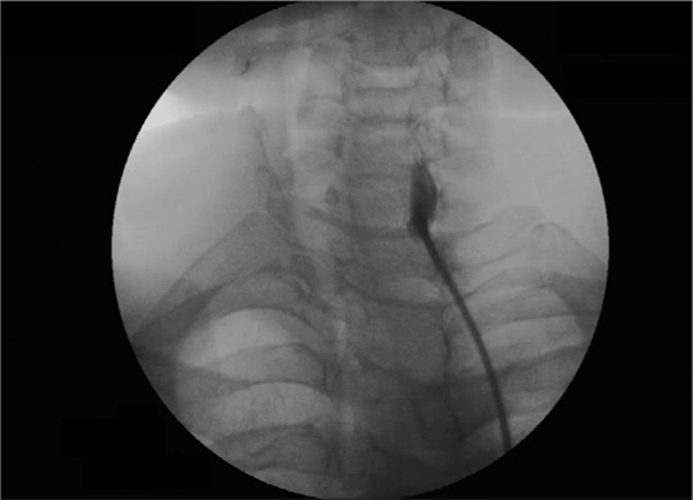 Cureus Dexmedetomidine as an Adjunct in a Fluoroscopically Guided
