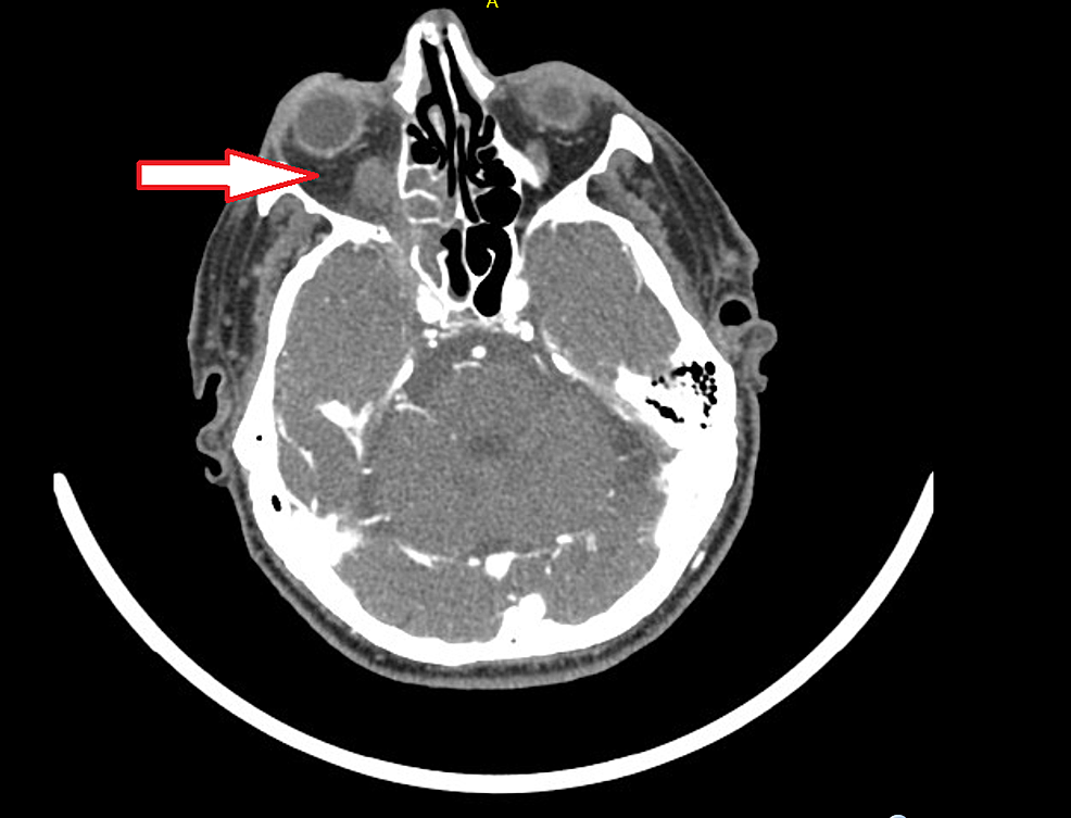 CT-head-concerning-for-invasive-fungal-sinusitis-with-abnormal-soft-tissue-infiltrating-the-orbital-apex-(arrow).
