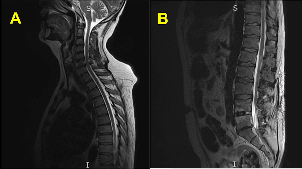 Cureus Guillain Barr Syndrome Presenting as Painful Weakness