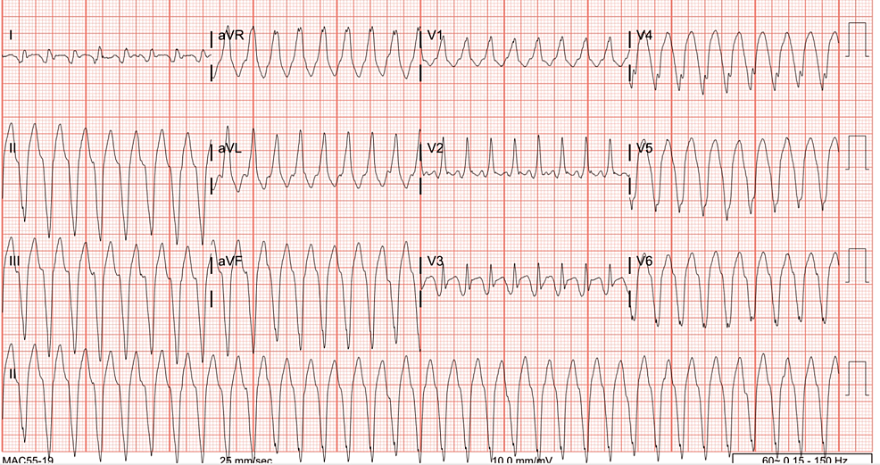 Sustained Ventricular Tachycardia Presenting As Gastrointestinal (GI ...