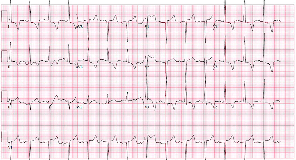 The impact of medical therapy on left ventricular strain: Current