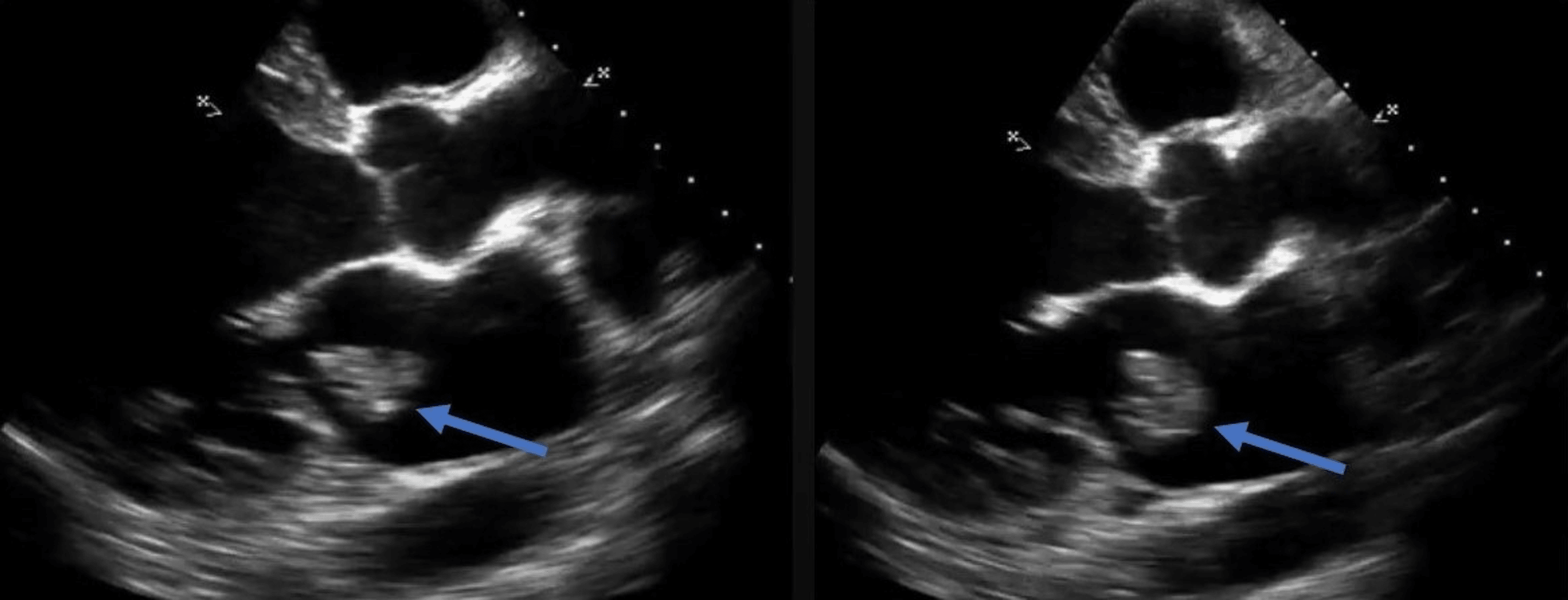 Cureus | Atrial Myxoma: An Unusual Etiology of Ischemic Stroke in an ...