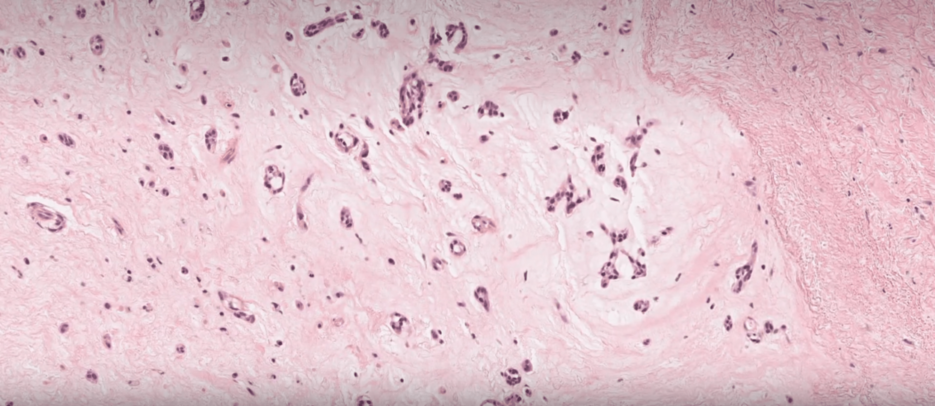 Cureus | Atrial Myxoma: An Unusual Etiology of Ischemic Stroke in an ...